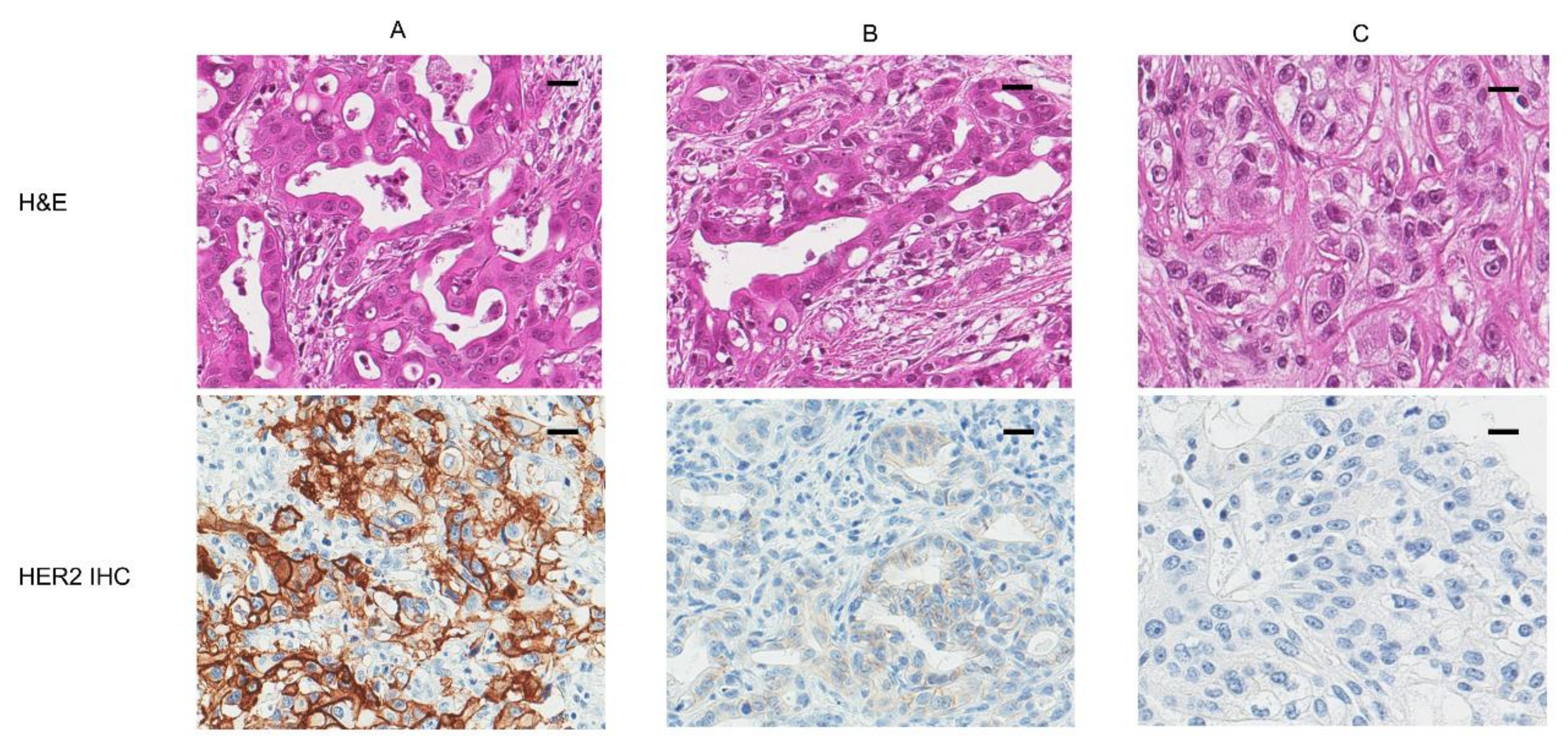 Diagnostics Free Full Text The Prognostic Impact Of Her2 Genetic And Protein Expression In Pancreatic Carcinoma Her2 Protein And Gene In Pancreatic Cancer Html