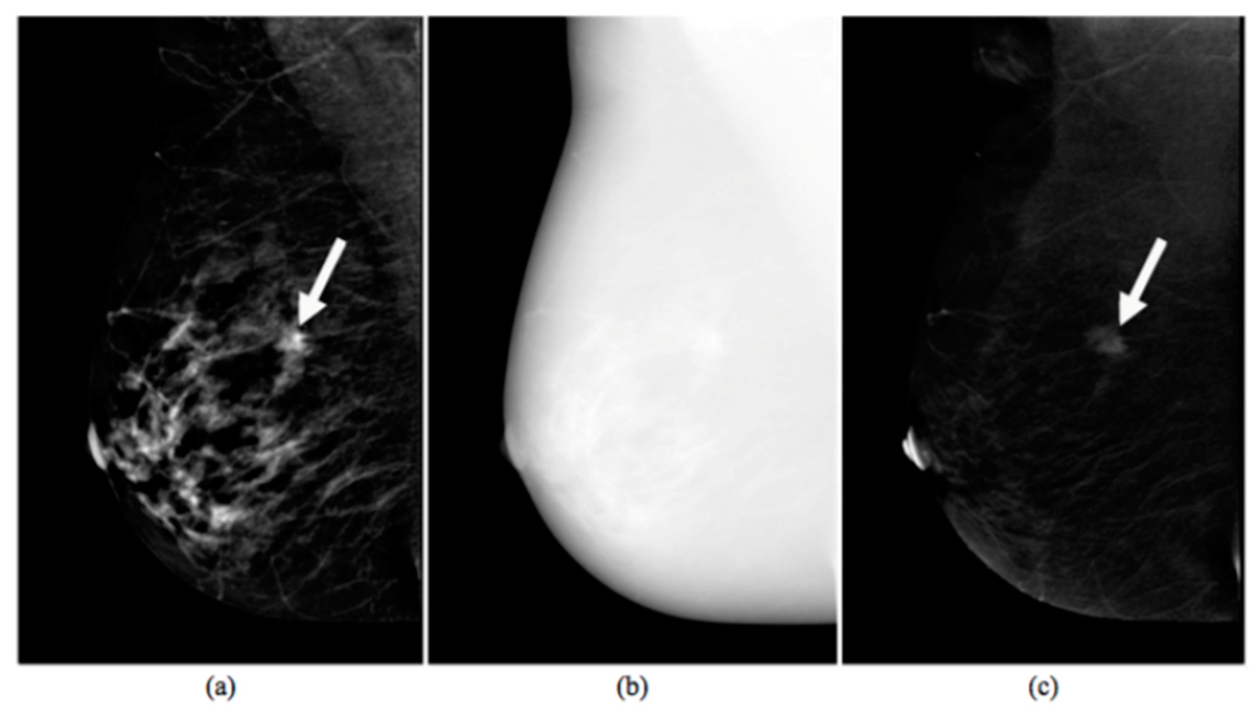 Eur J Breast Health on X: Accurate Estimation of Breast Tumor