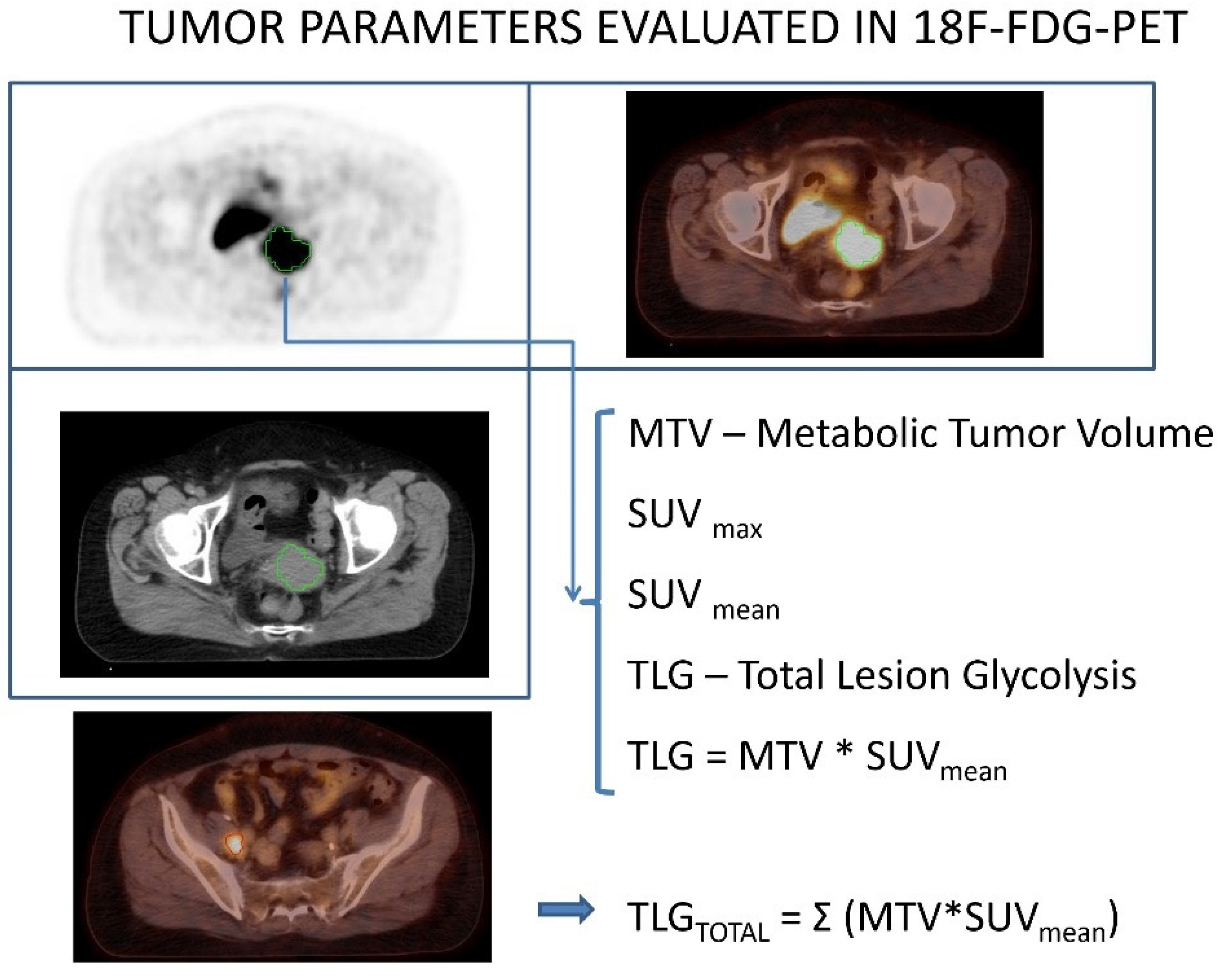 tildele kedelig udtryk Diagnostics | Free Full-Text | Pretreatment [18F]FDG PET/CT Prognostic  Factors in Patients with Squamous Cell Cervical Carcinoma FIGO IIIC1