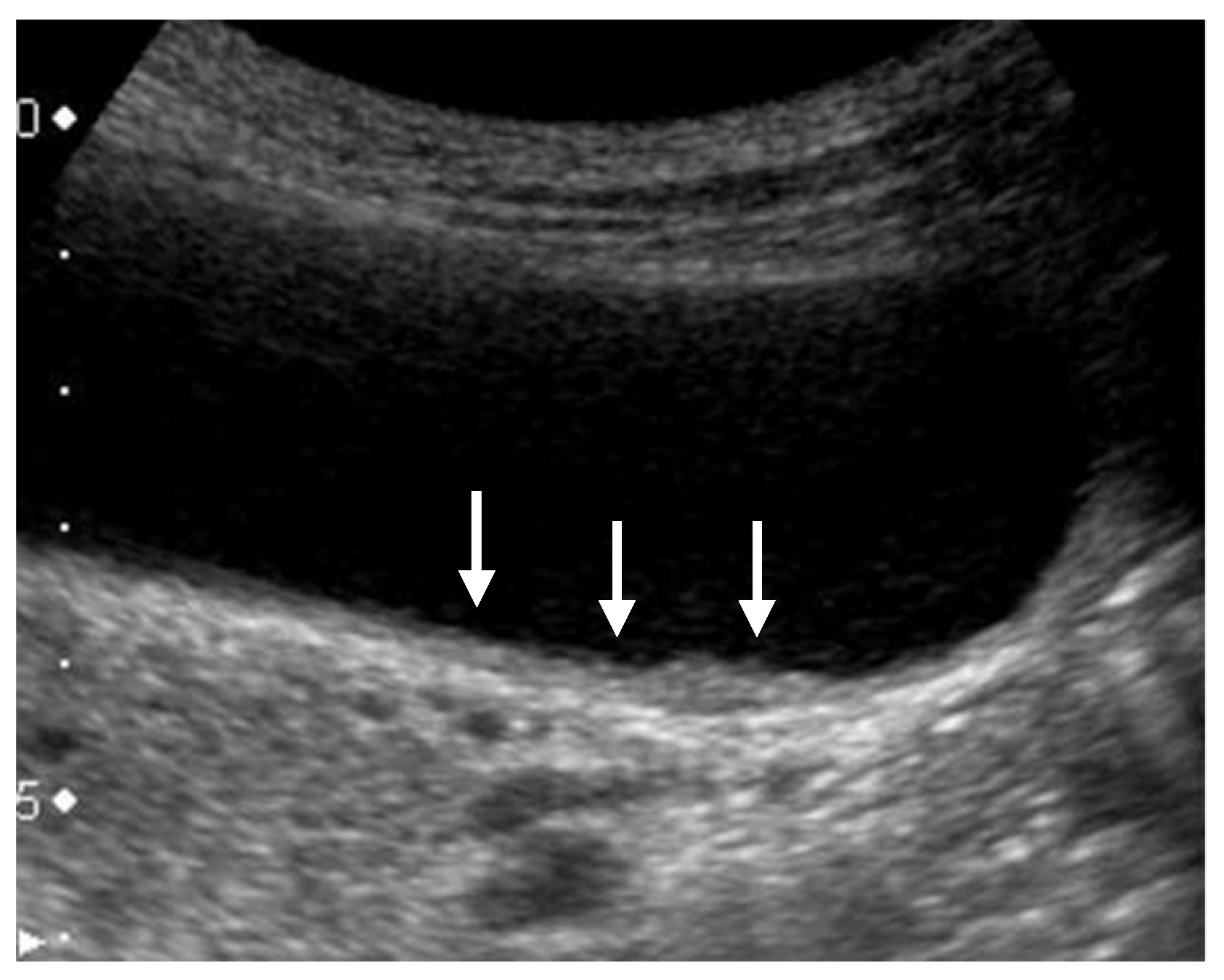 gallbladder ultrasound cancer