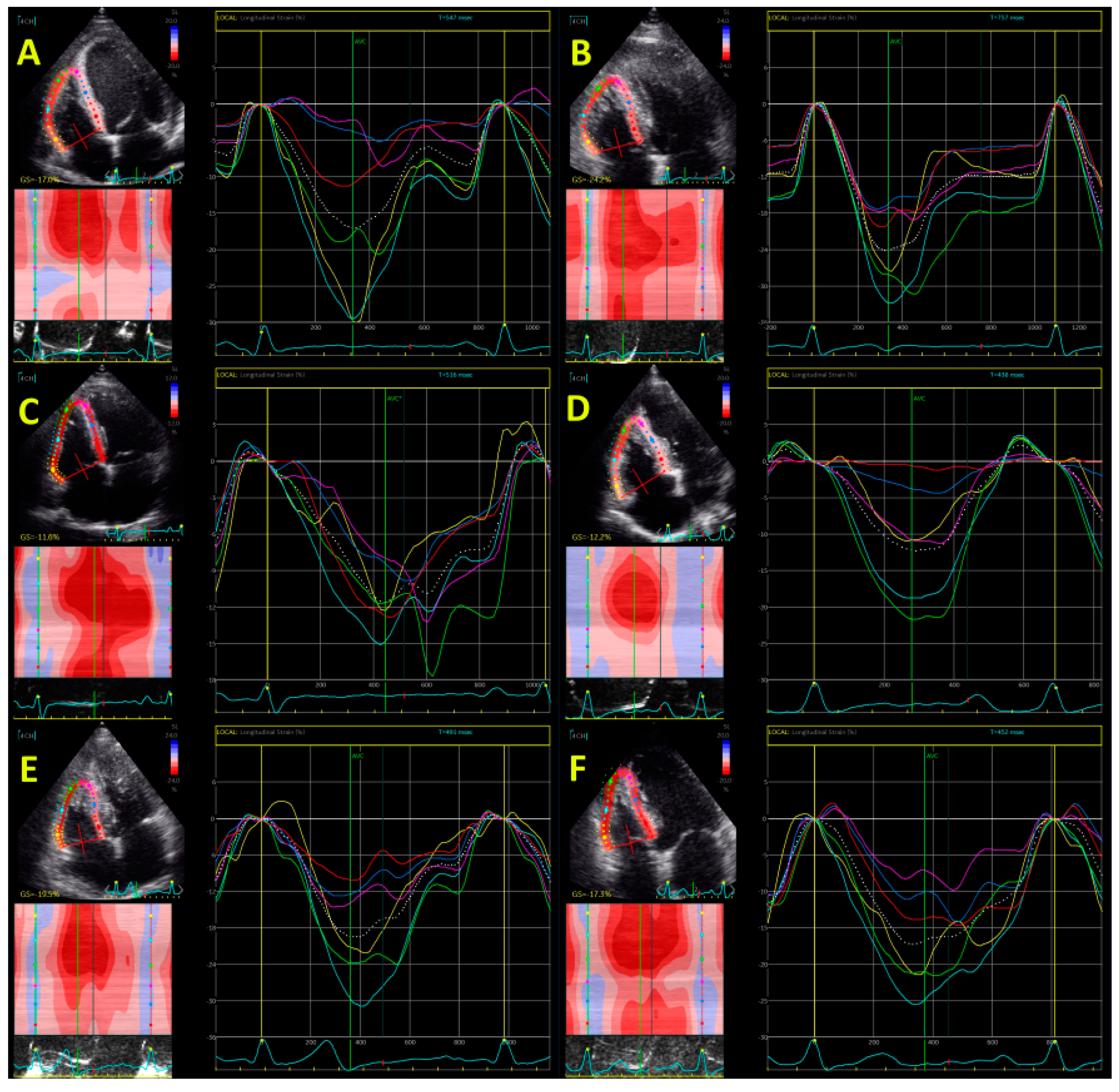 JACC Journals on X: Easing the strain of family screening in dilated  #cardiomyopathy (DCM). New #JACCIMG study finds #EchoFirst global  longitudinal strain adds prognostic value beyond normal #LVEF for  asymptomatic relatives of