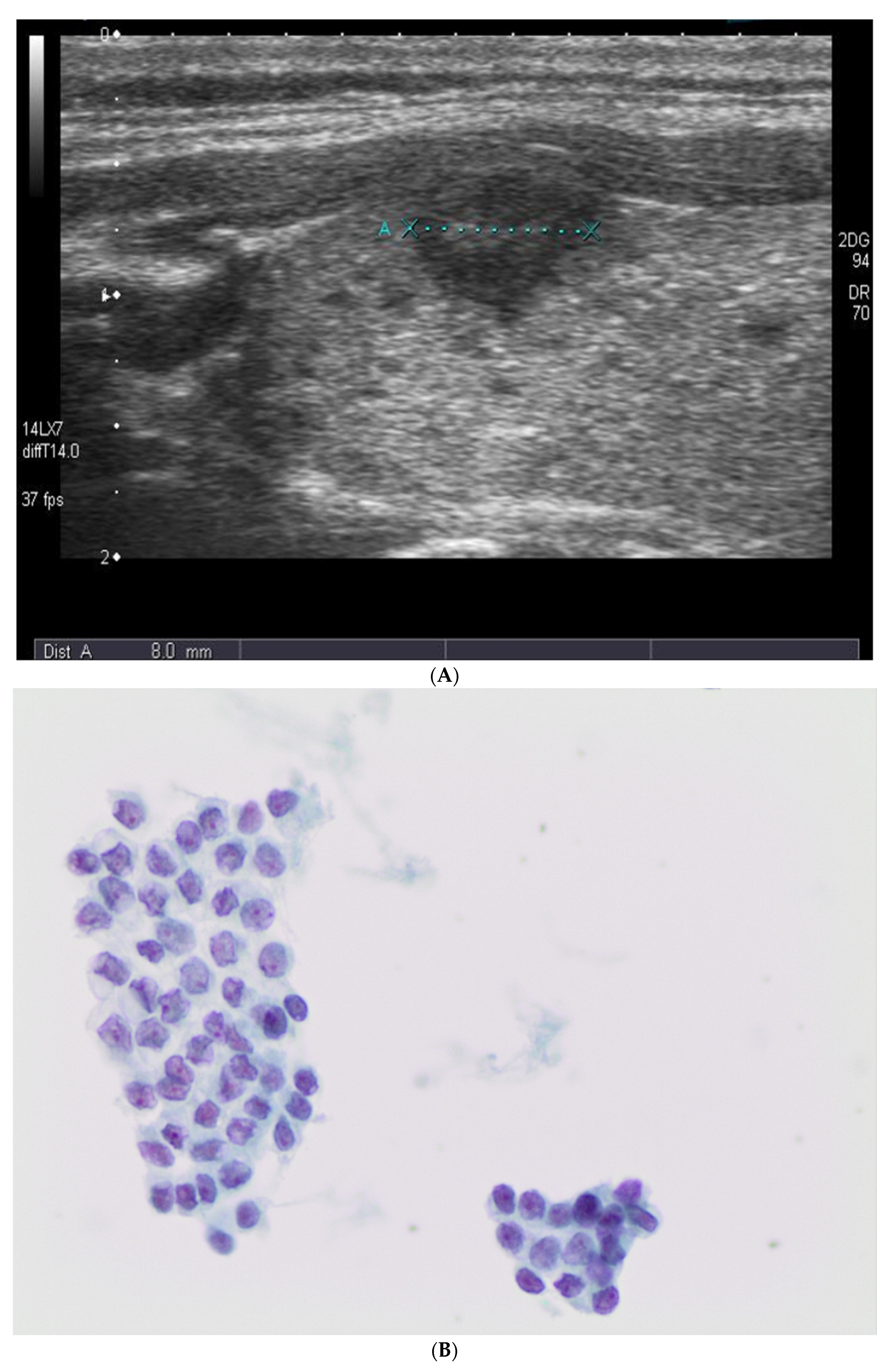 Comparison of cytological adequacy and pain scale score in  ultrasound-guided fine-needle aspiration of solid thyroid nodules for  liquid-based cytology with with 23- and 25-gauge needles: a single-center  prospective study