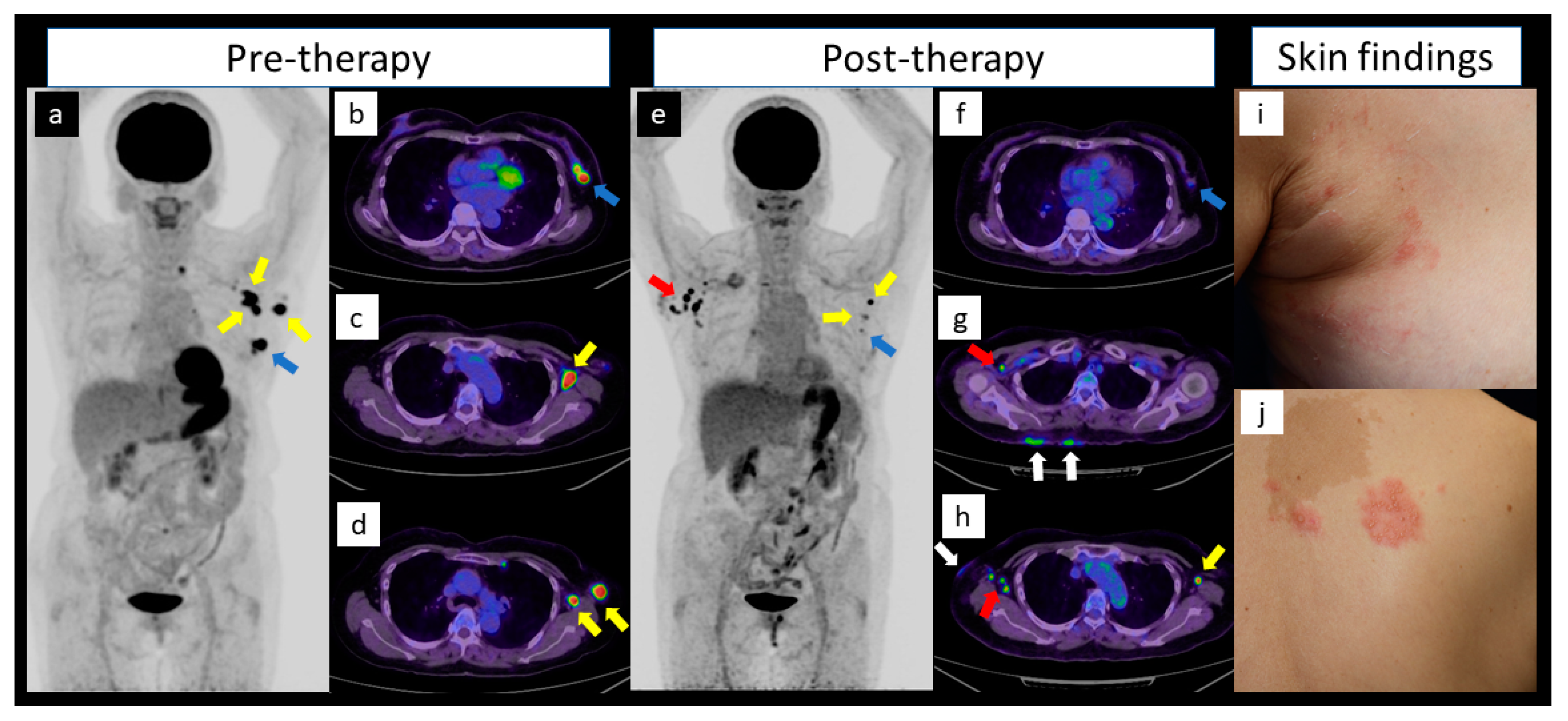 Diagnostics | Free Full-Text | Active Herpes Zoster Mimicking Worsening of  Axillary Lymph Node Metastases of Breast Cancer after Chemotherapy on  18F-Fluorodeoxyglucose Positron-Emission Tomography/Computed Tomography