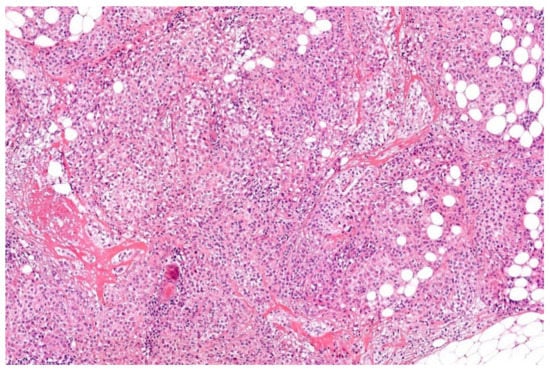 Primary merkel cell carcinoma clinically presenting as deep oedematous mass  of the groin, European Journal of Medical Research