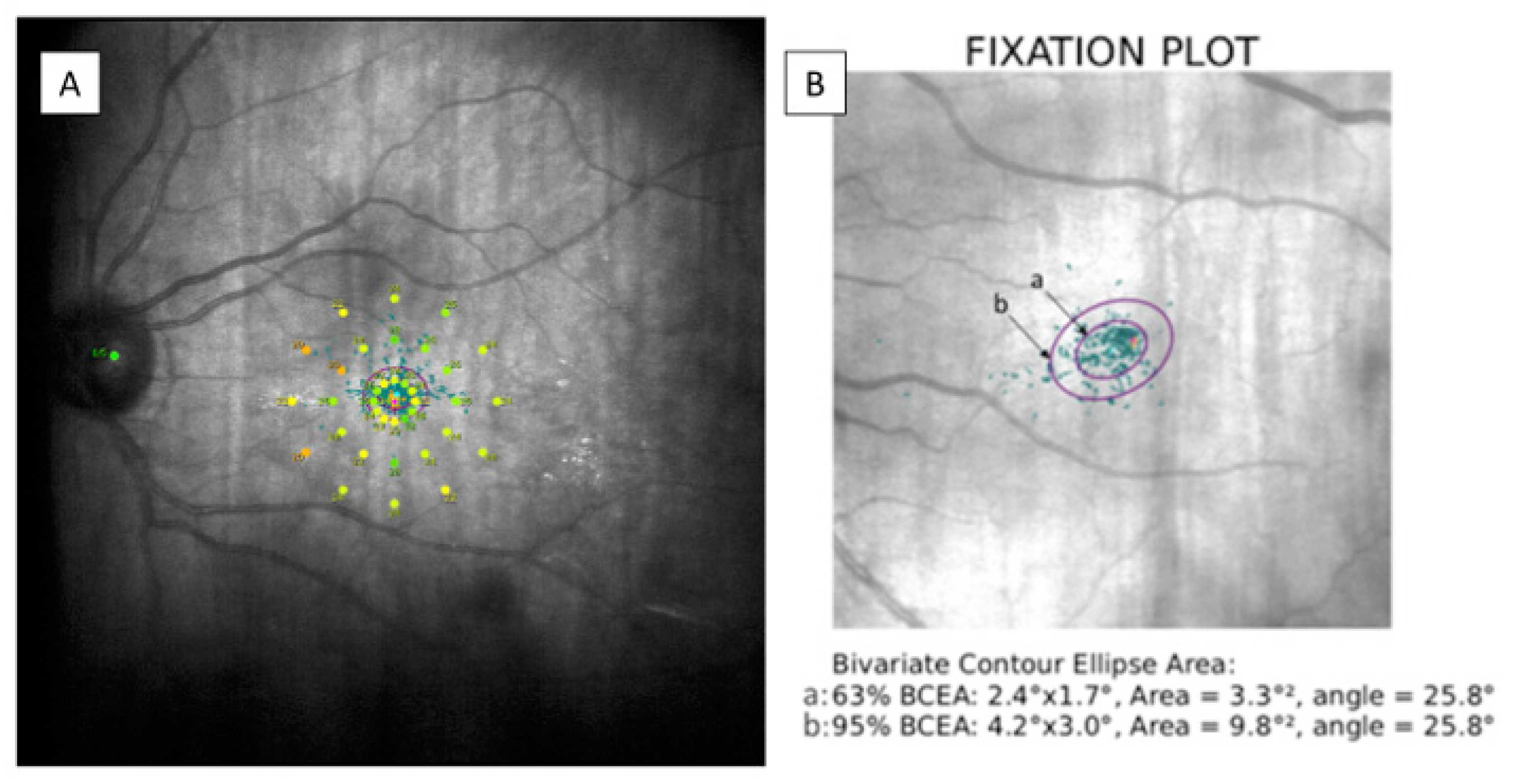 Diagnostics | Free Full-Text | Microperimetry-Assessed Functional  Alterations and OCT-Changes in Patients after Retinal Detachment Surgery  Using Pars Plana Vitrectomy and SF6 Tamponade | HTML