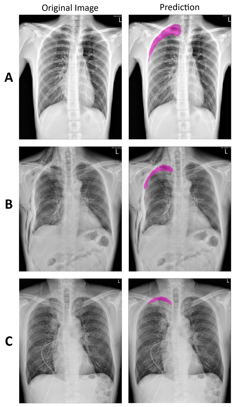 mild pneumothorax x ray