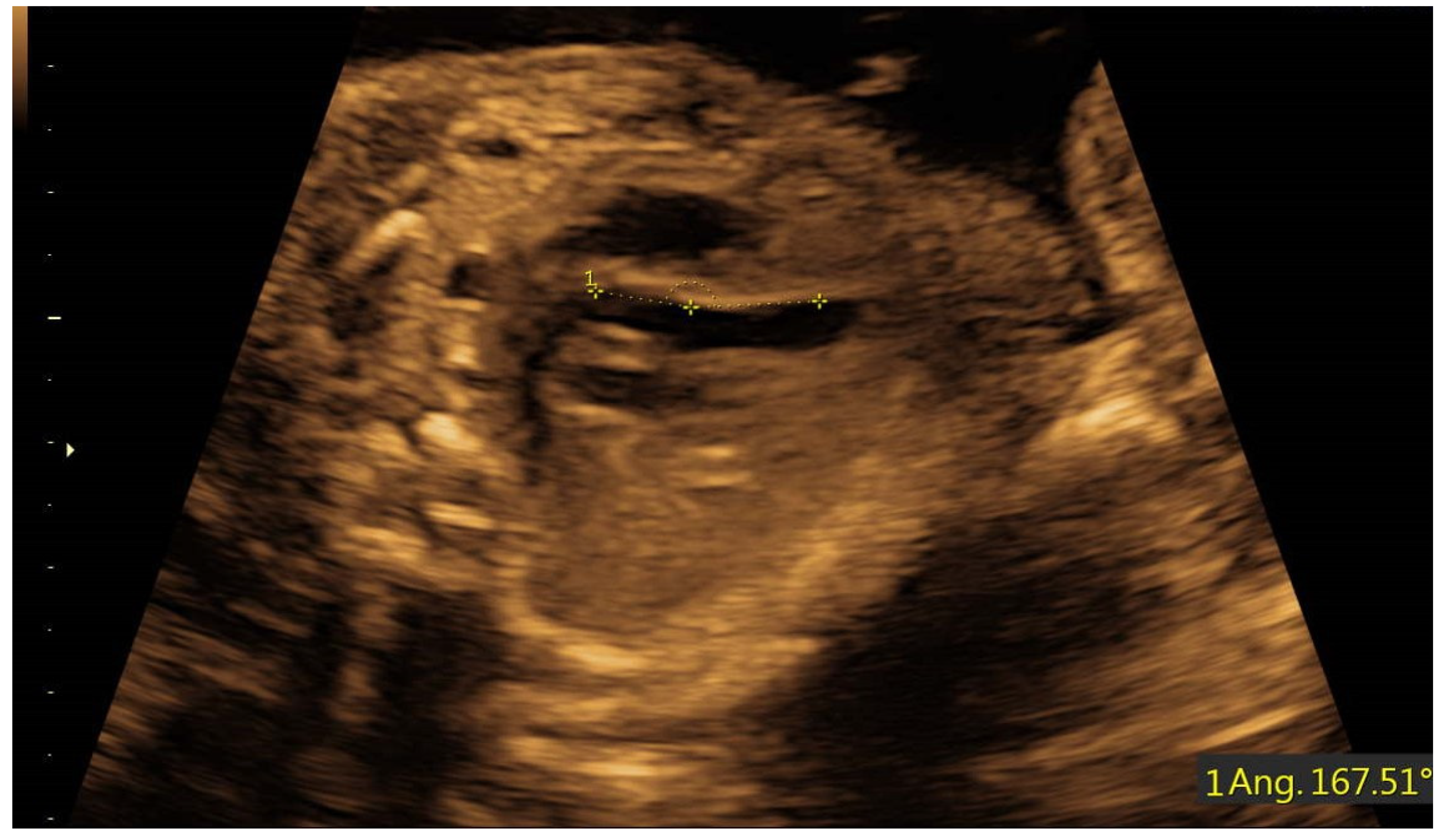 fetal lvot ultrasound