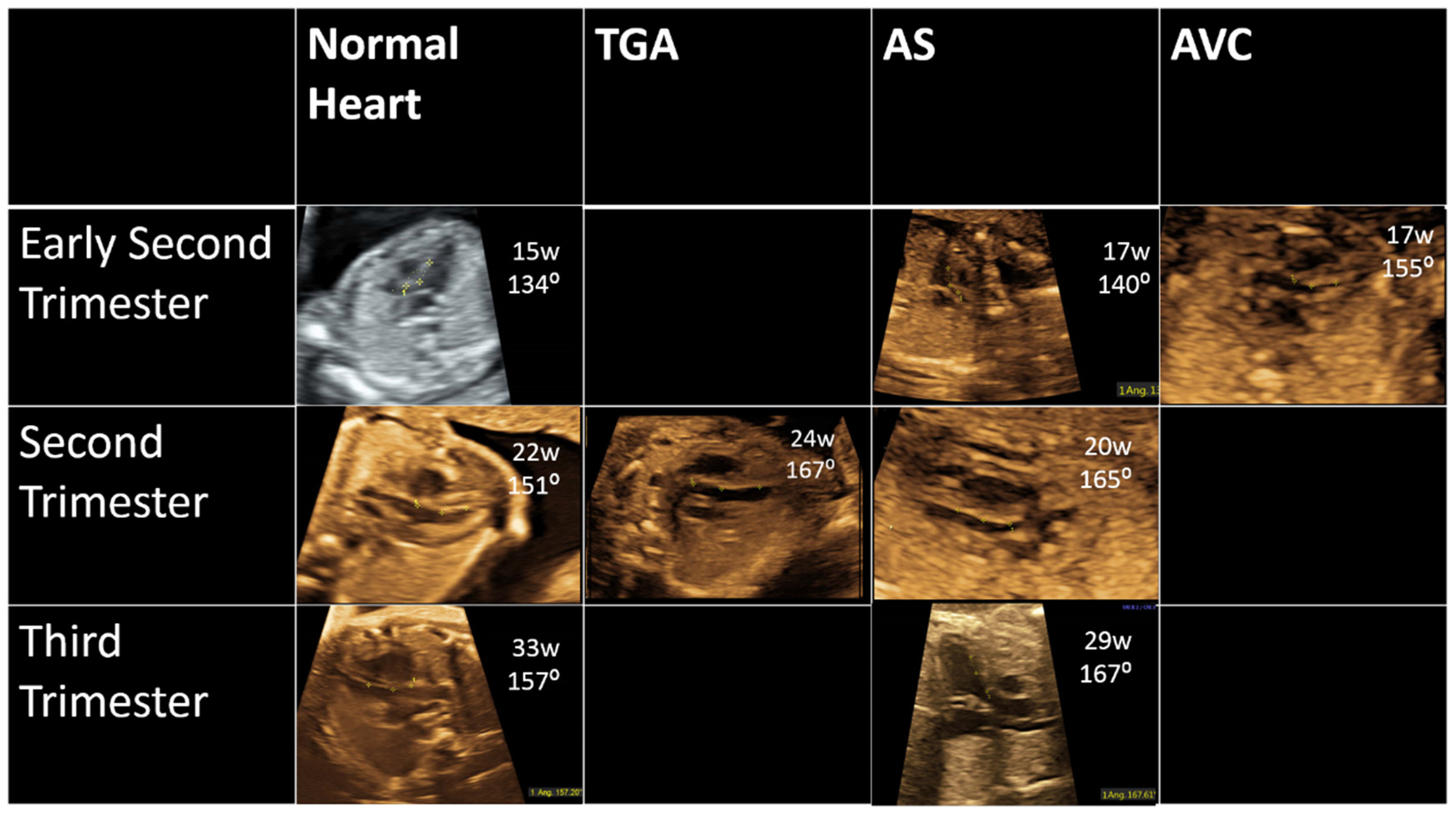 fetal lvot ultrasound