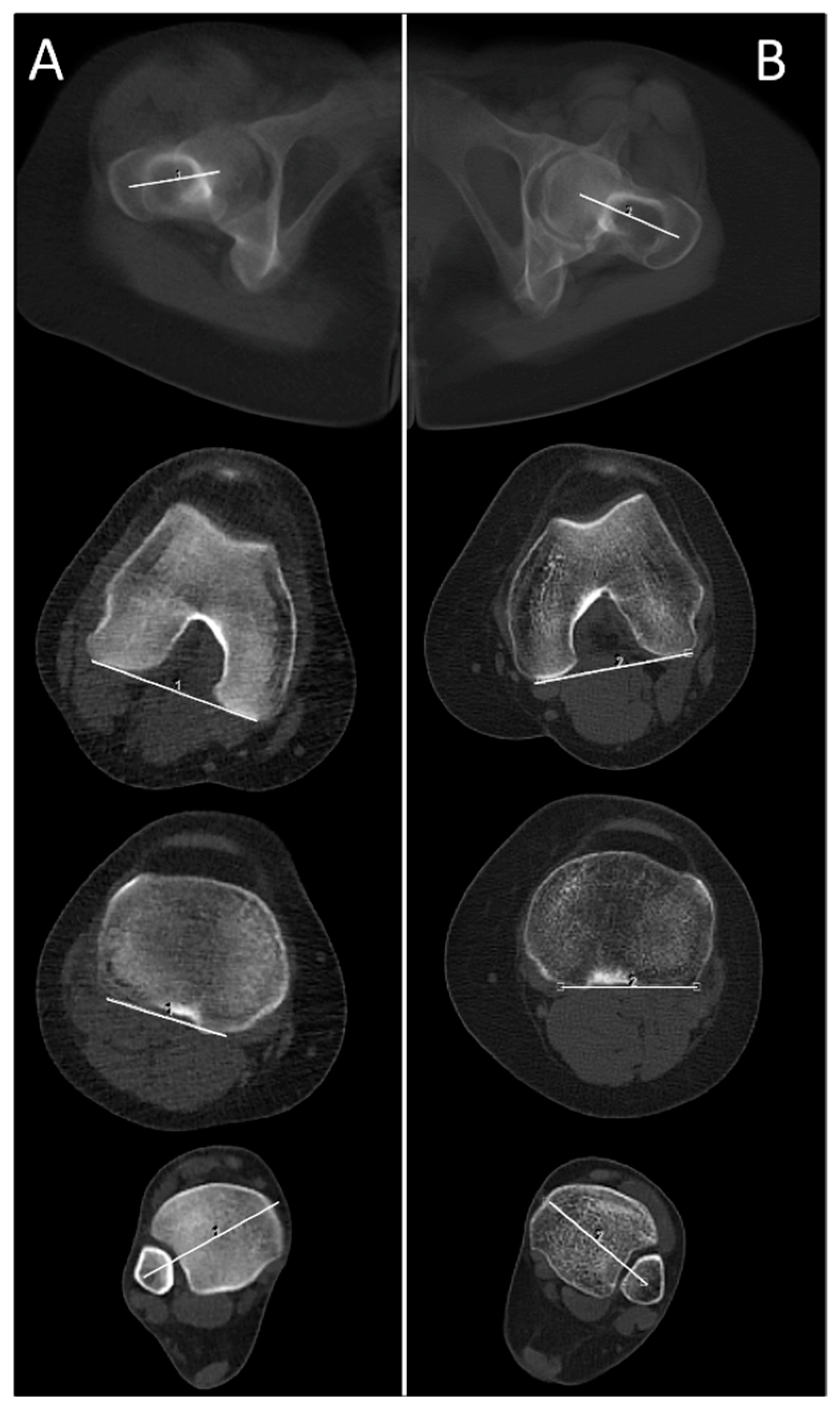 Diagnostics | Free Full-Text | Radiation Dose Reduction in CT Torsion  Measurement of the Lower Limb: Introduction of a New Ultra-Low Dose Protocol