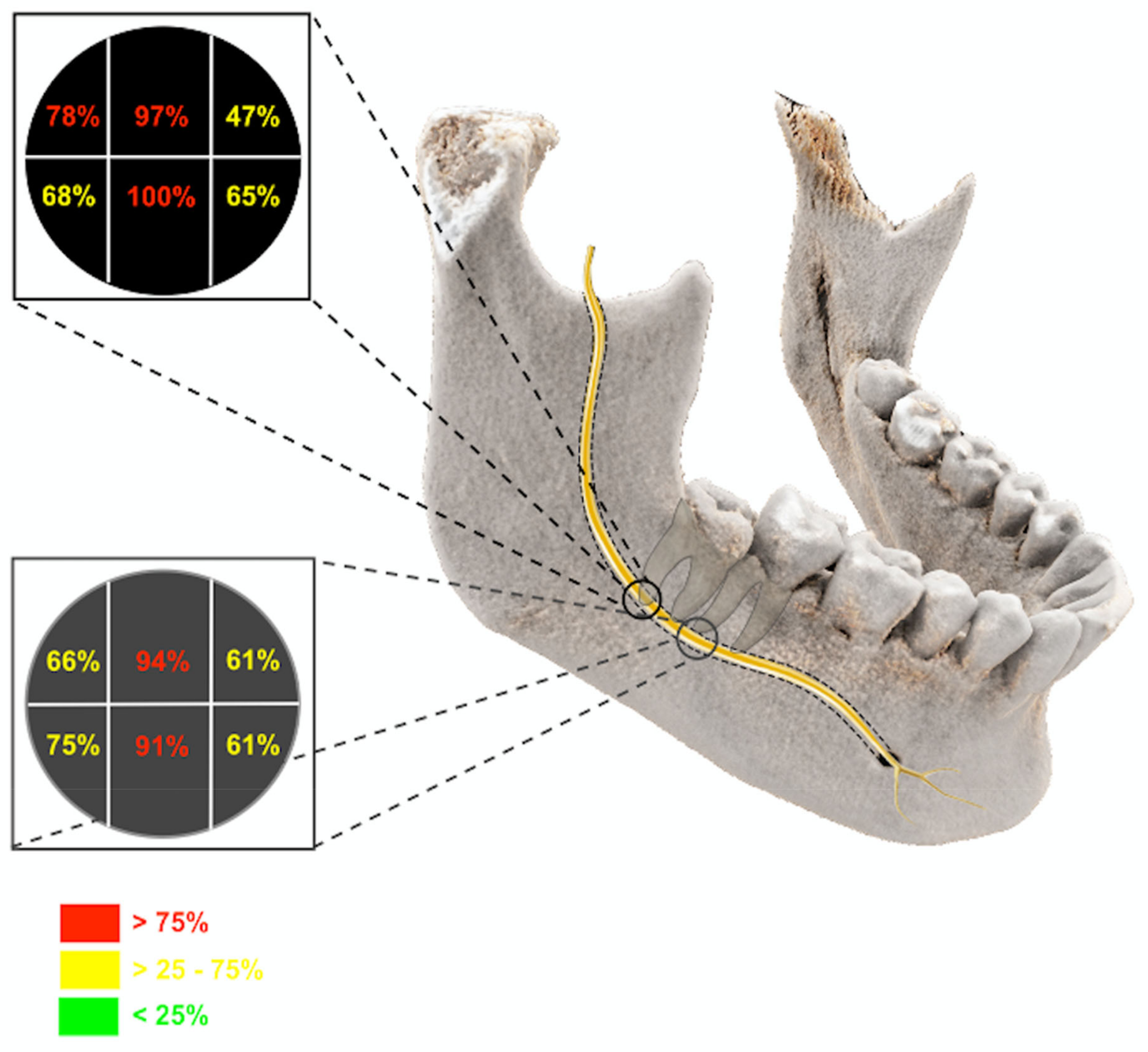 TOOTH ANATOMY (ANA), MANDIBULAR NERVE MODEL [PE-ANA012]