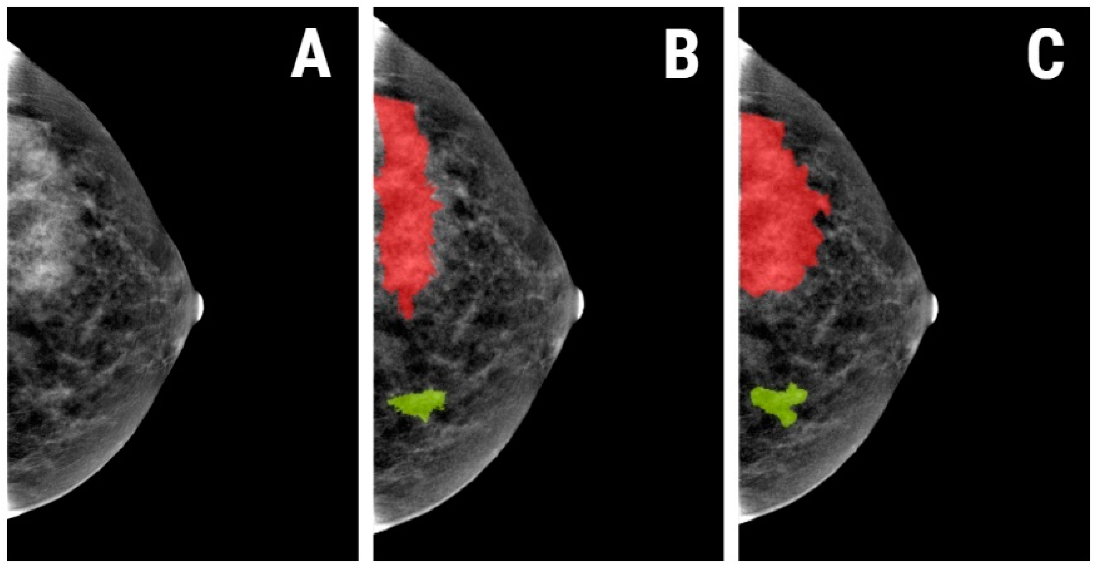 Diagnostics Free Full Text Differentiating Breast Tumors From Background Parenchymal