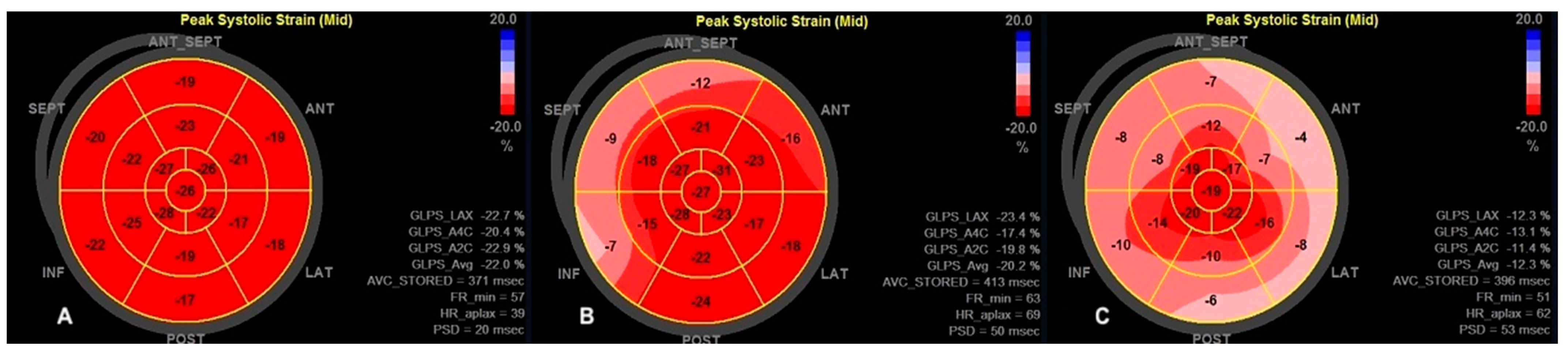 Examples of the longitudinal strain bull's eye plot in a patient with