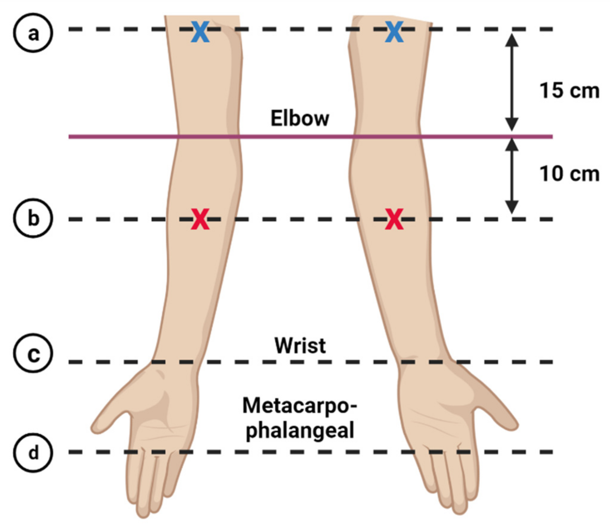 Diagnostics Free Full Text Assessment Of Potential Risk Factors And Skin Ultrasound Presentation Associated With Breast Cancer Related Lymphedema In Long Term Breast Cancer Survivors Html