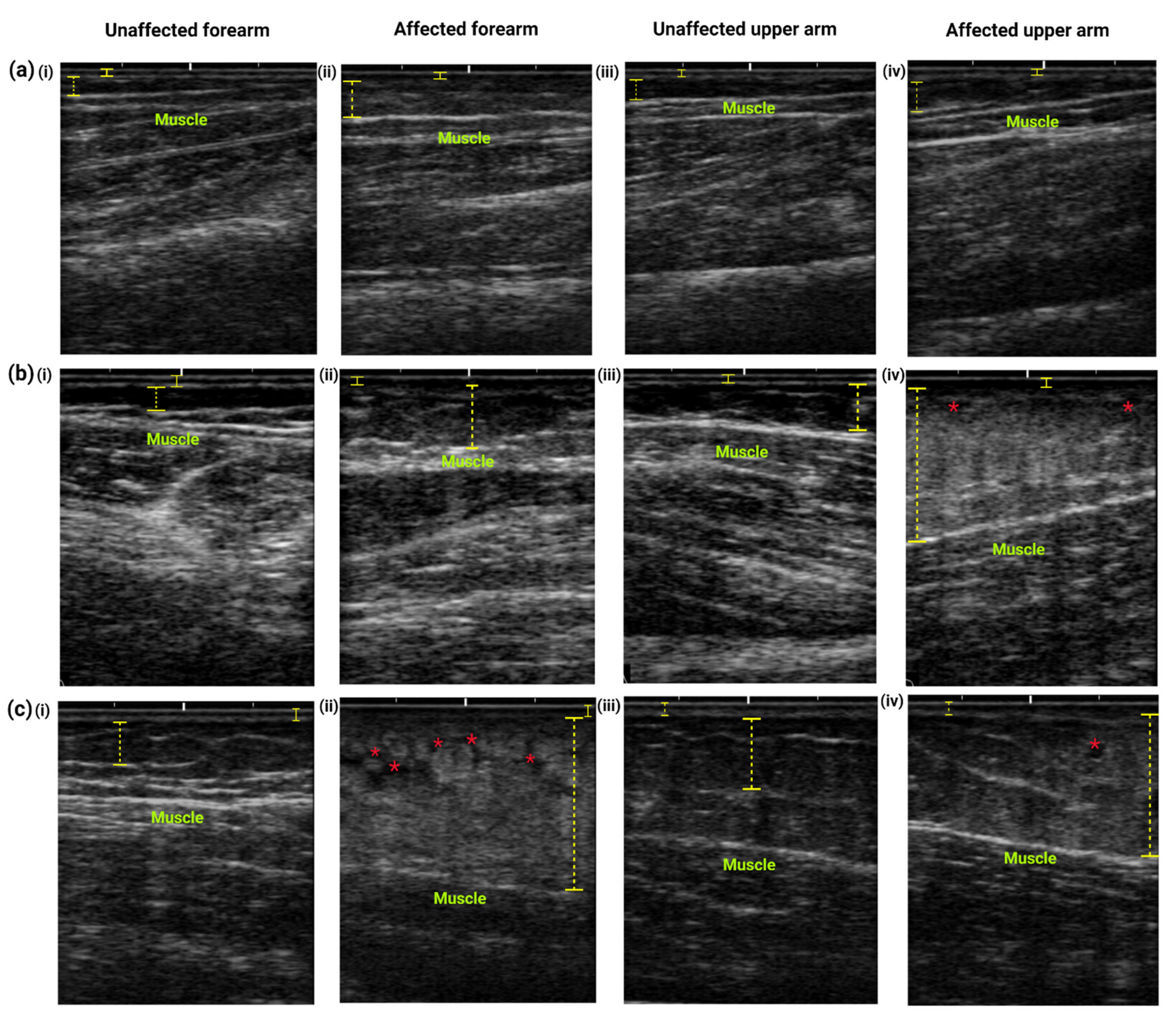 Diagnostics Free Full Text Assessment Of Potential Risk Factors And Skin Ultrasound Presentation Associated With Breast Cancer Related Lymphedema In Long Term Breast Cancer Survivors Html