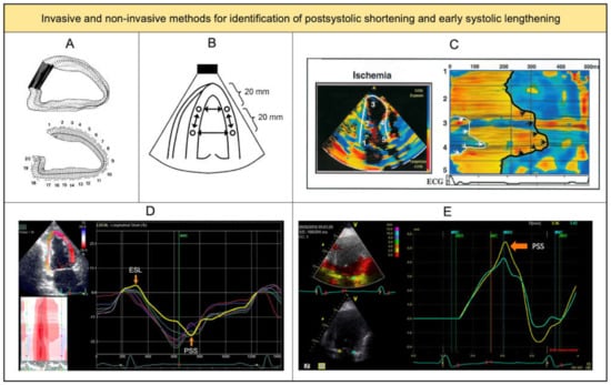 Post-systolic shortening is superior to global longitudinal strain