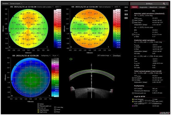 itrace posterior corneal aberrations