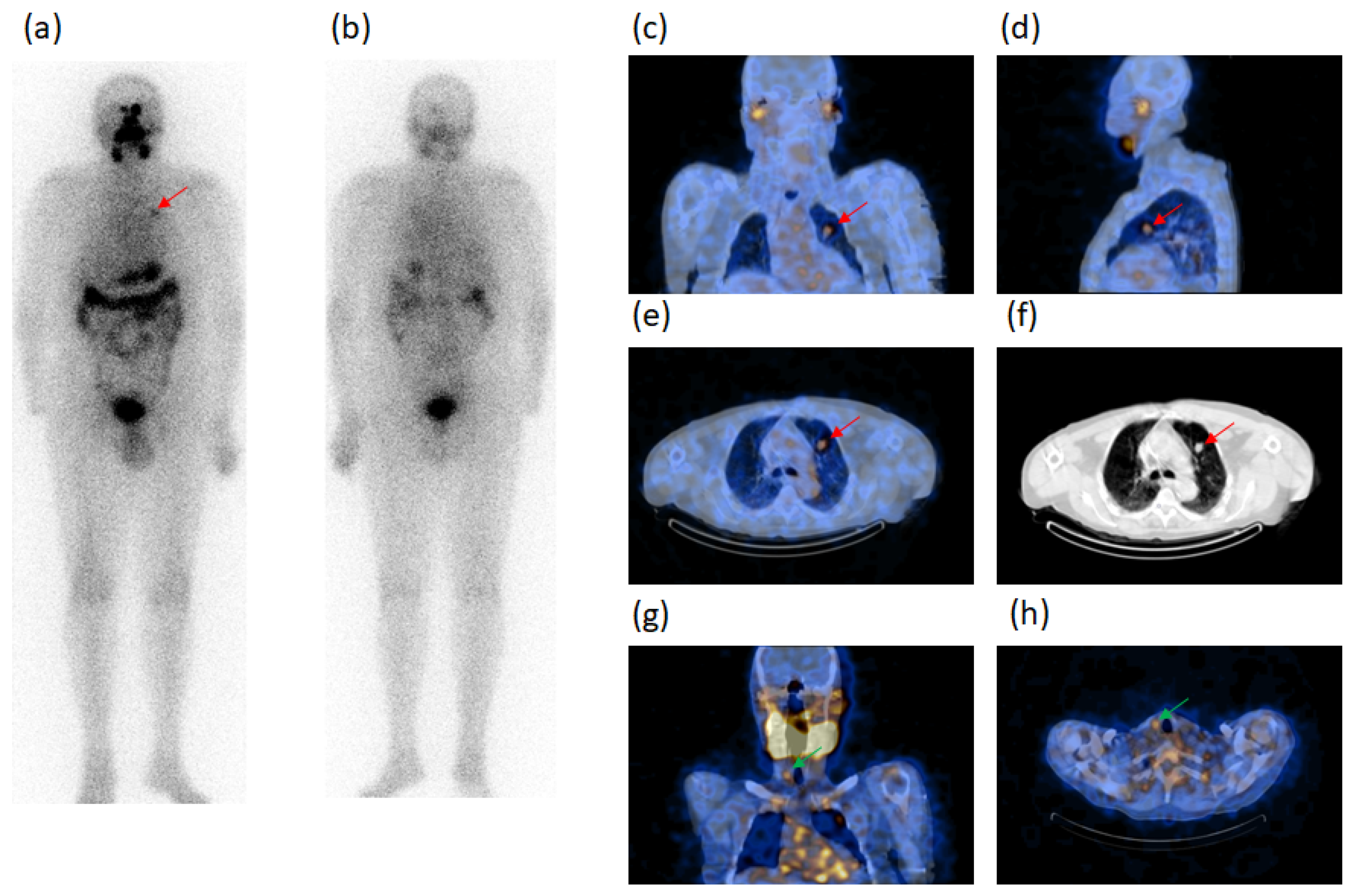 Diagnostics | Free Full-Text | The Diagnostic Usefulness of 131I-SPECT/CT  at Both Radioiodine Ablation and during Long-Term Follow-Up in Patients  Thyroidectomized for Differentiated Thyroid Carcinoma: Analysis of Tissue  Risk Factors Ascertained at