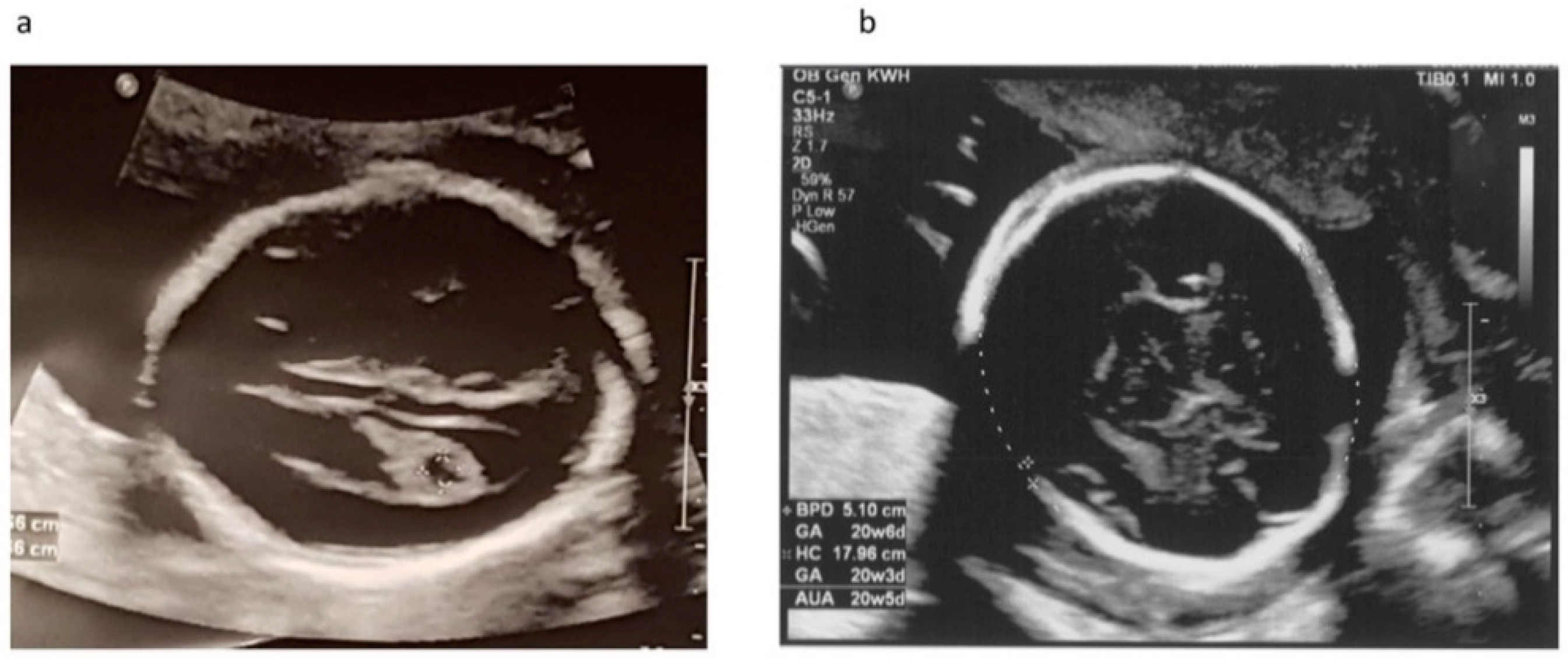 microphthalmia ultrasound