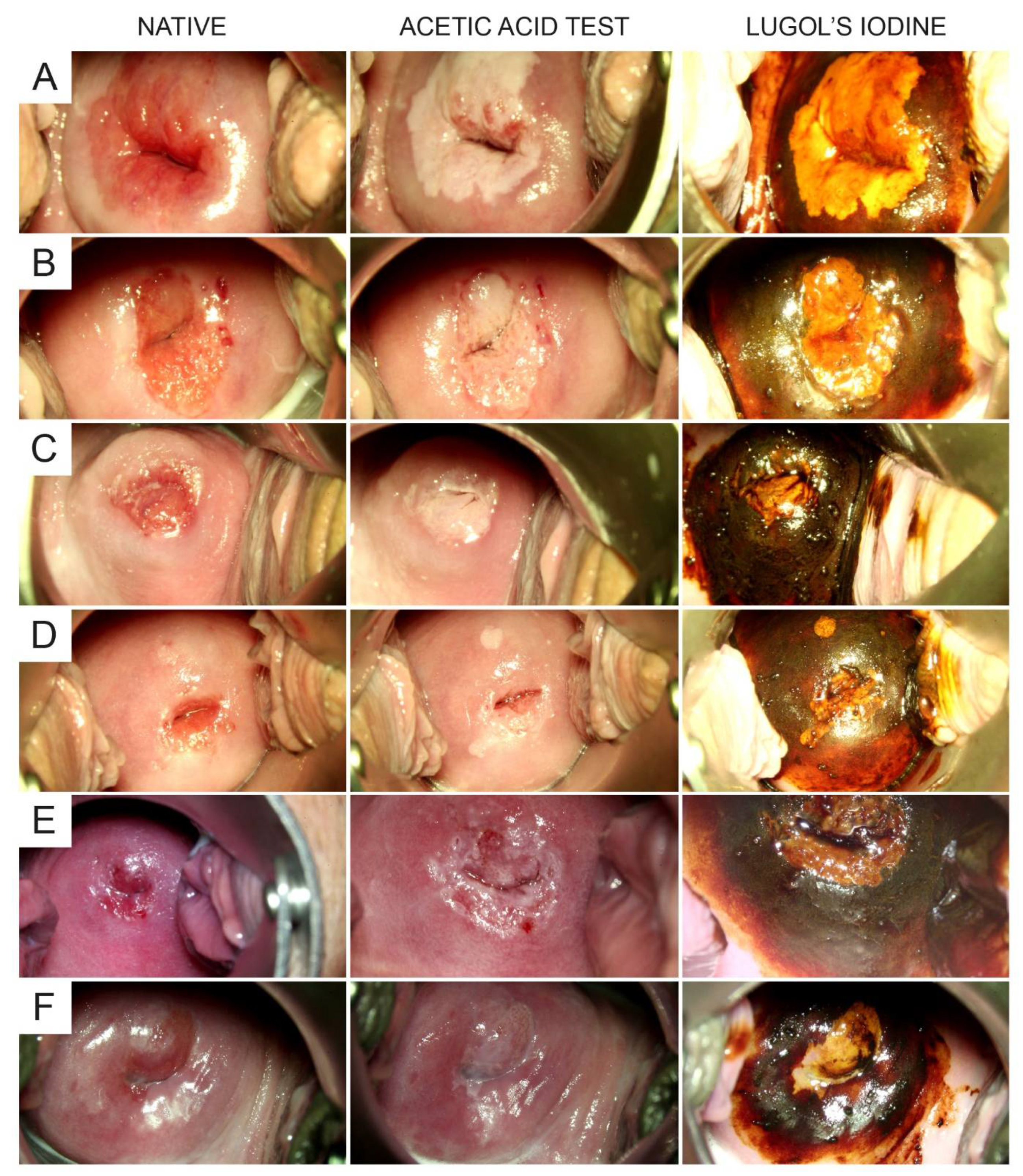 Atlas of visual inspection of the cervix with acetic acid for