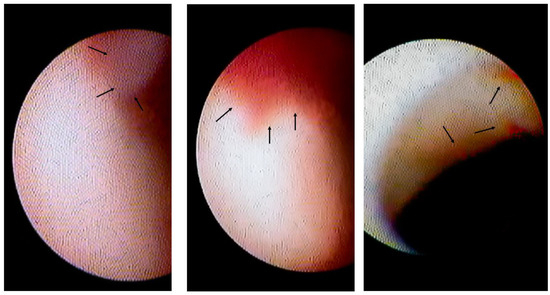 Diagnostics Free Full Text Intracoronary Thrombogenicity In Patients With Vasospastic Angina