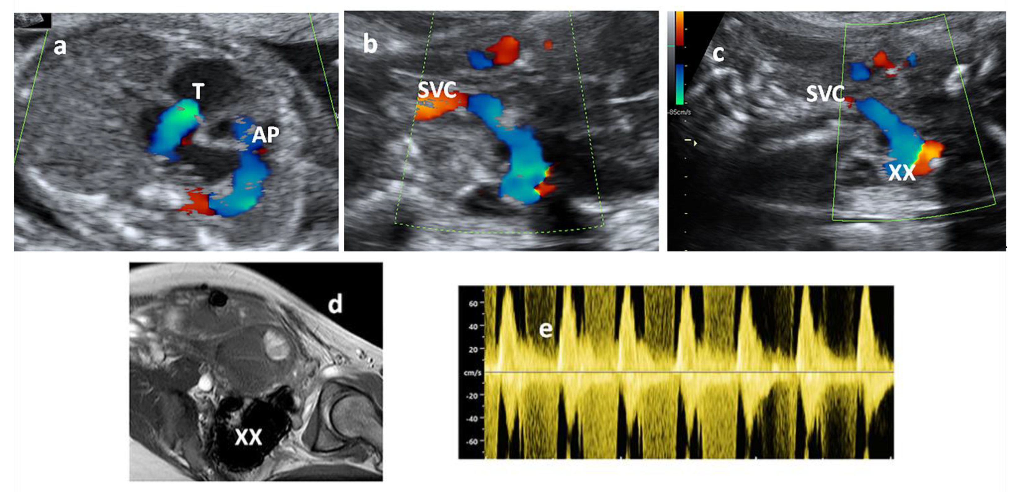 Diagnostics | Free Full-Text | Dural Sinus Arteriovenous Malformation in  the Fetus. Case Report and Discussion of the Literature