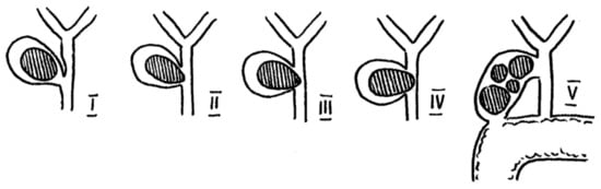 Diagnostics Free Full Text The Current Approach To The Diagnosis And Classification Of Mirizzi Syndrome Html