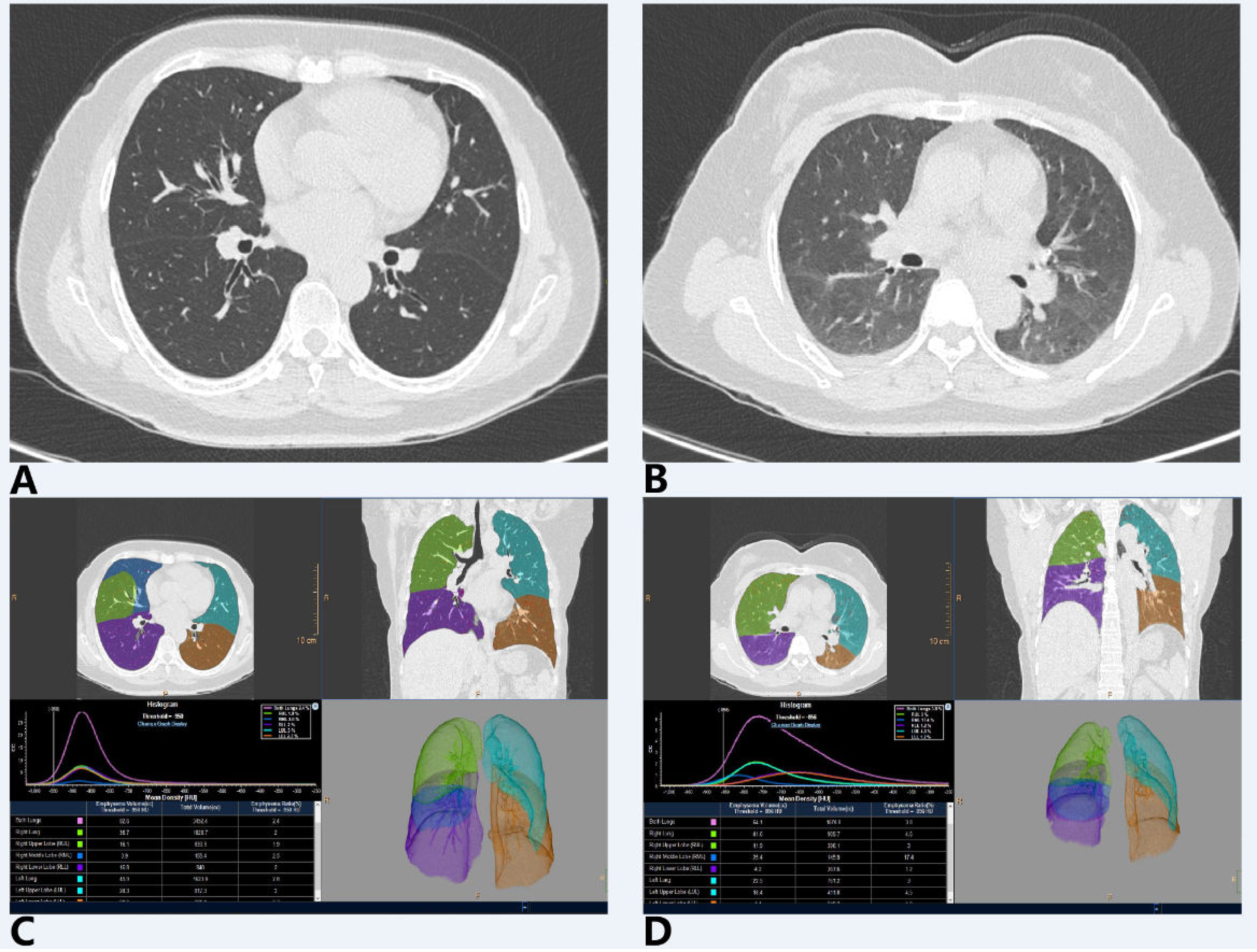 Diagnostics | Free Full-Text | Total Lung and Lobar Quantitative Assessment  Based on Paired Inspiratory–Expiratory Chest CT in Healthy Adults:  Correlation with Pulmonary Ventilatory Function