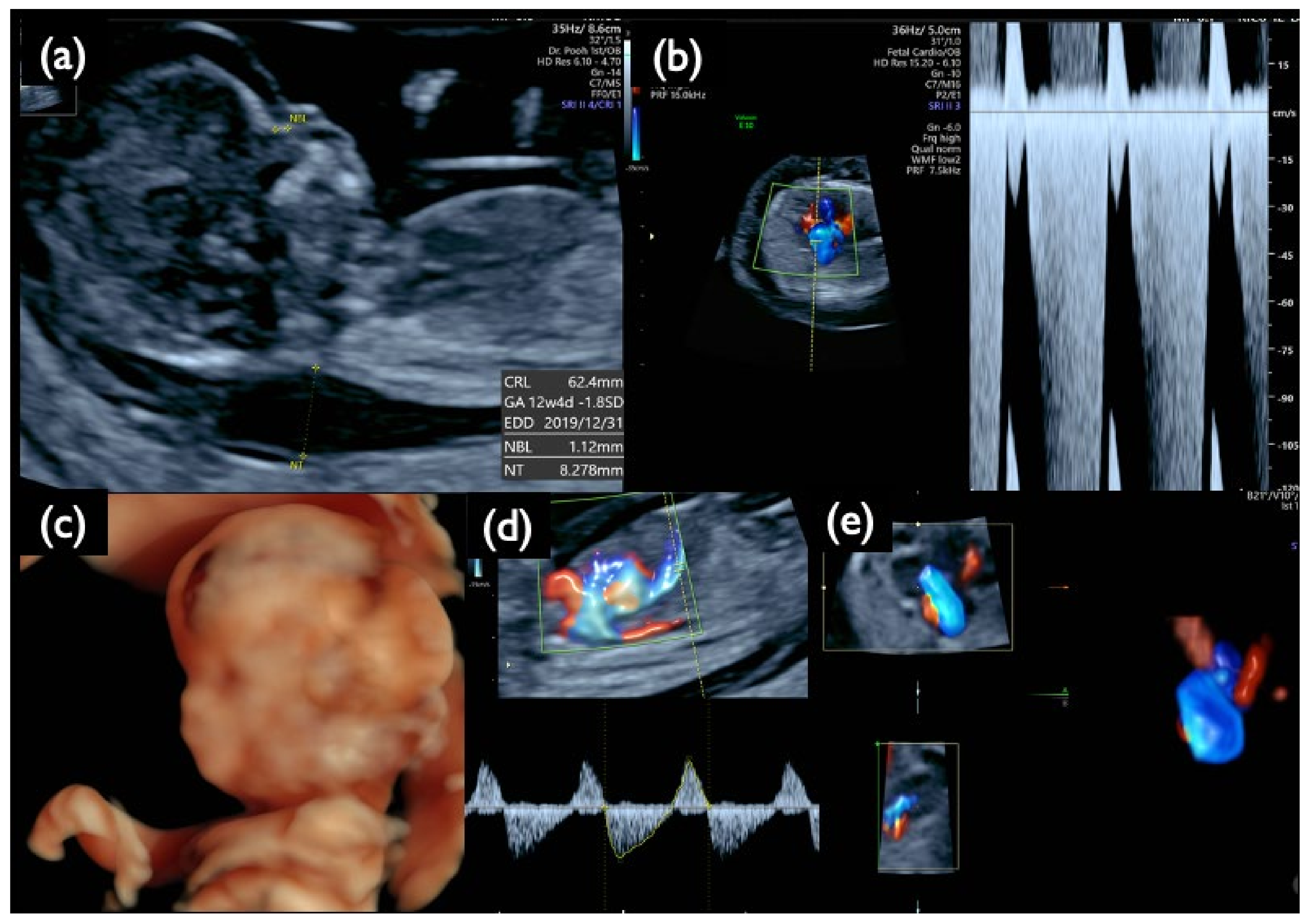 Diagnostics Free Full Text Clinical Validation Of Fetal Cfdna Analysis Using Rolling Circle 