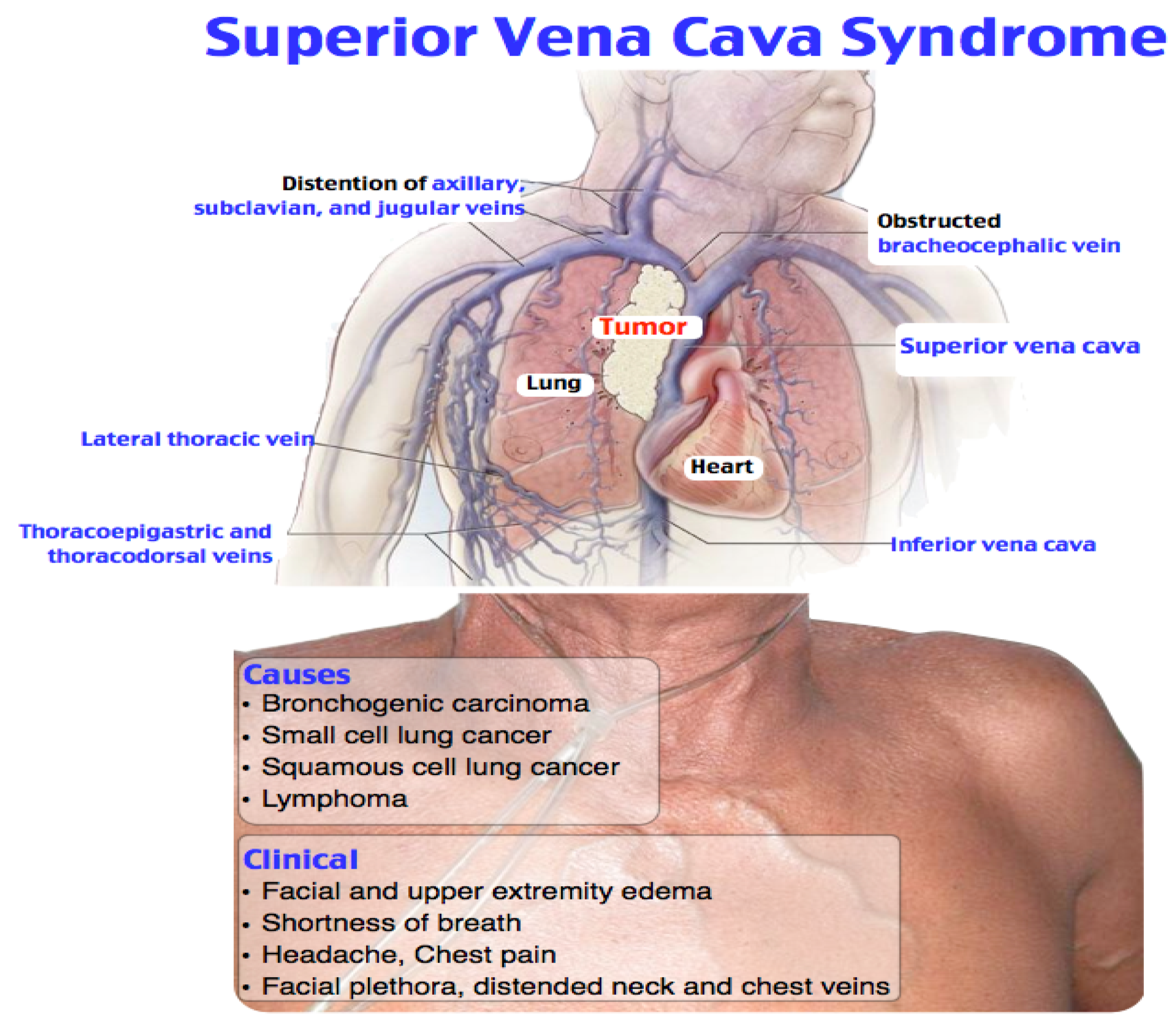 Diagnostics | Free Full-Text | Clinical or Imaging Diagnosis of the Current  Medical Practice for Superior Vena Cava Syndrome?