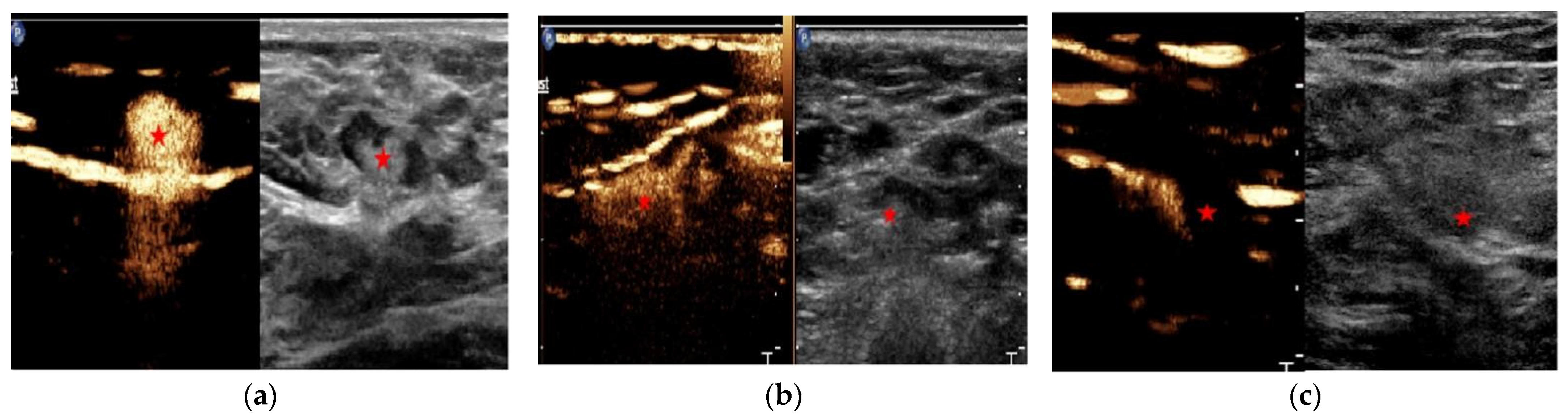 Diagnostics Free Full Text Contrast Enhanced Ultrasound For Precise Sentinel Lymph Node 