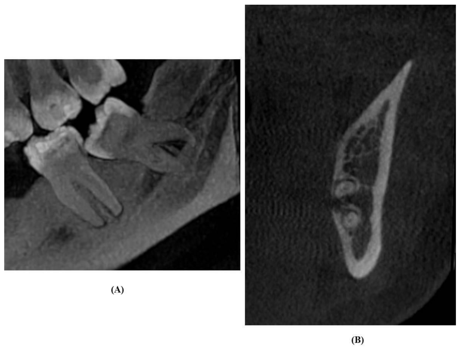 Diagnostics | Free Full-Text | Comparison of Digital OPG and CBCT in  Assessment of Risk Factors Associated with Inferior Nerve Injury during  Mandibular Third Molar Surgery