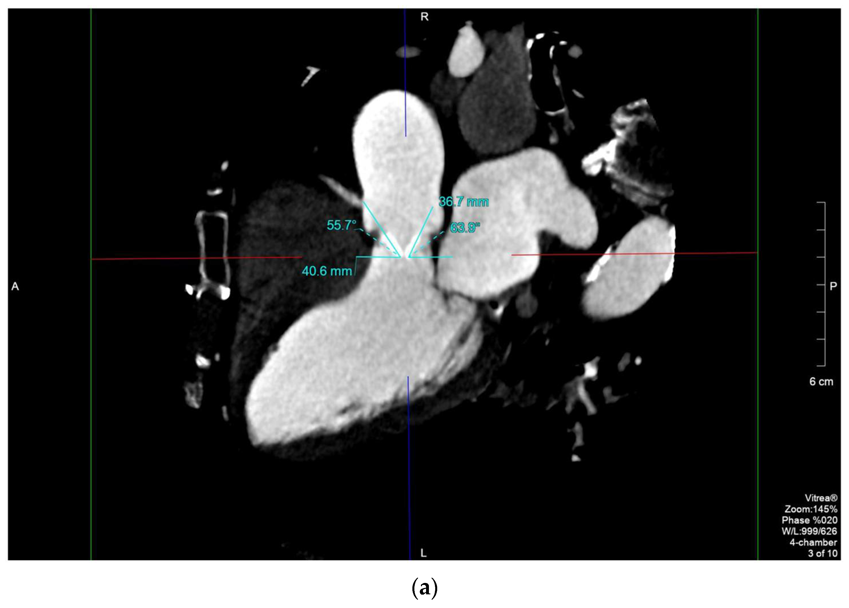 Diagnostics | Free Full-Text | Challenging Cases of Aortic