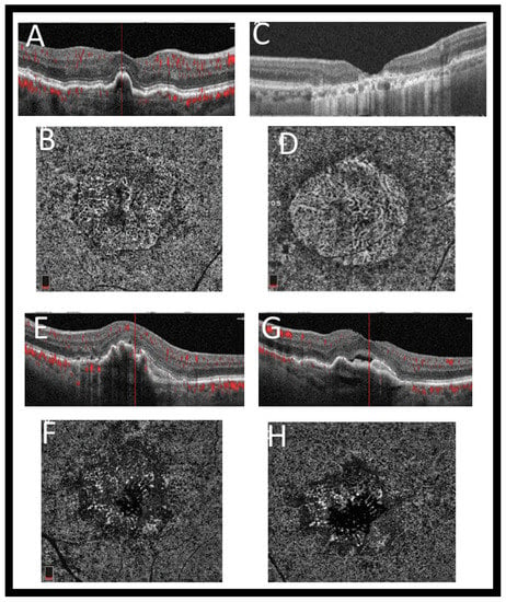 Diagnostics | Free Full-Text | Role of Optical Coherence Tomography Imaging  in Predicting Progression of Age-Related Macular Disease: A Survey