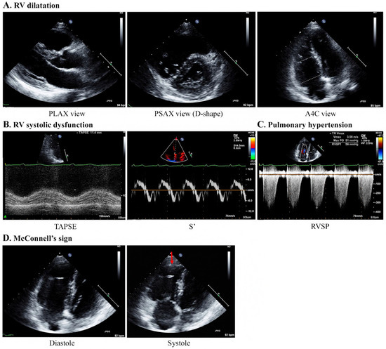 Diagnostics | Free Full-Text | Echocardiographic Assessment of Patients  with Pulmonary Tumor Thrombotic Microangiopathy First Diagnosed in the  Emergency Department