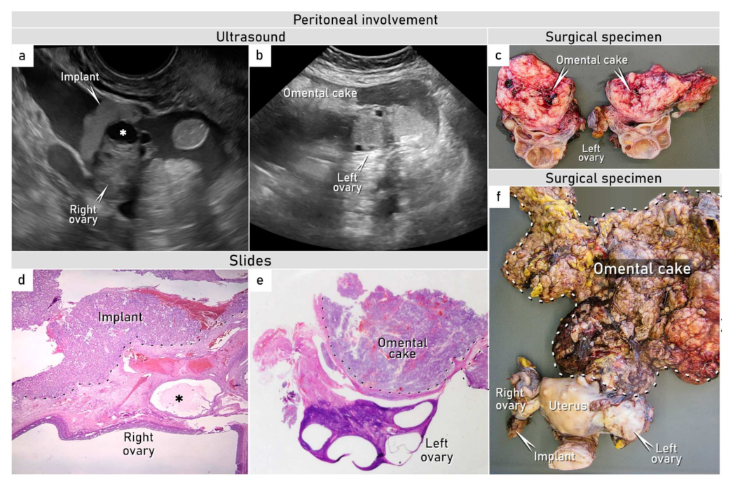 ovarian yolk sac tumor ultrasound