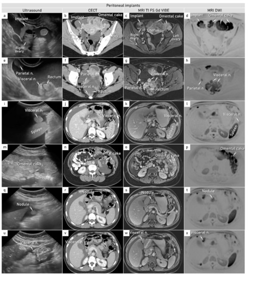 CT and MR imaging of the greater omentum: Pictorial essay