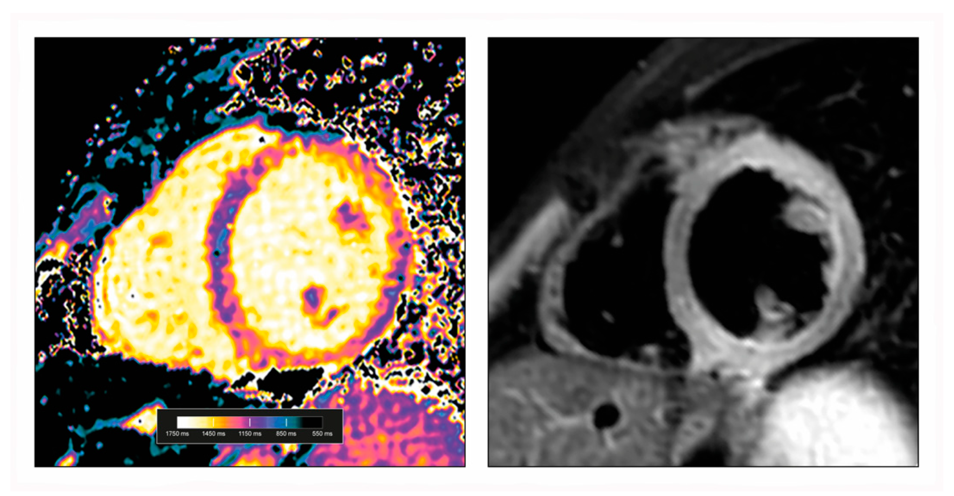 Diagnostics | Free Full-Text | Cardiovascular Magnetic Resonance in  Myocarditis | HTML