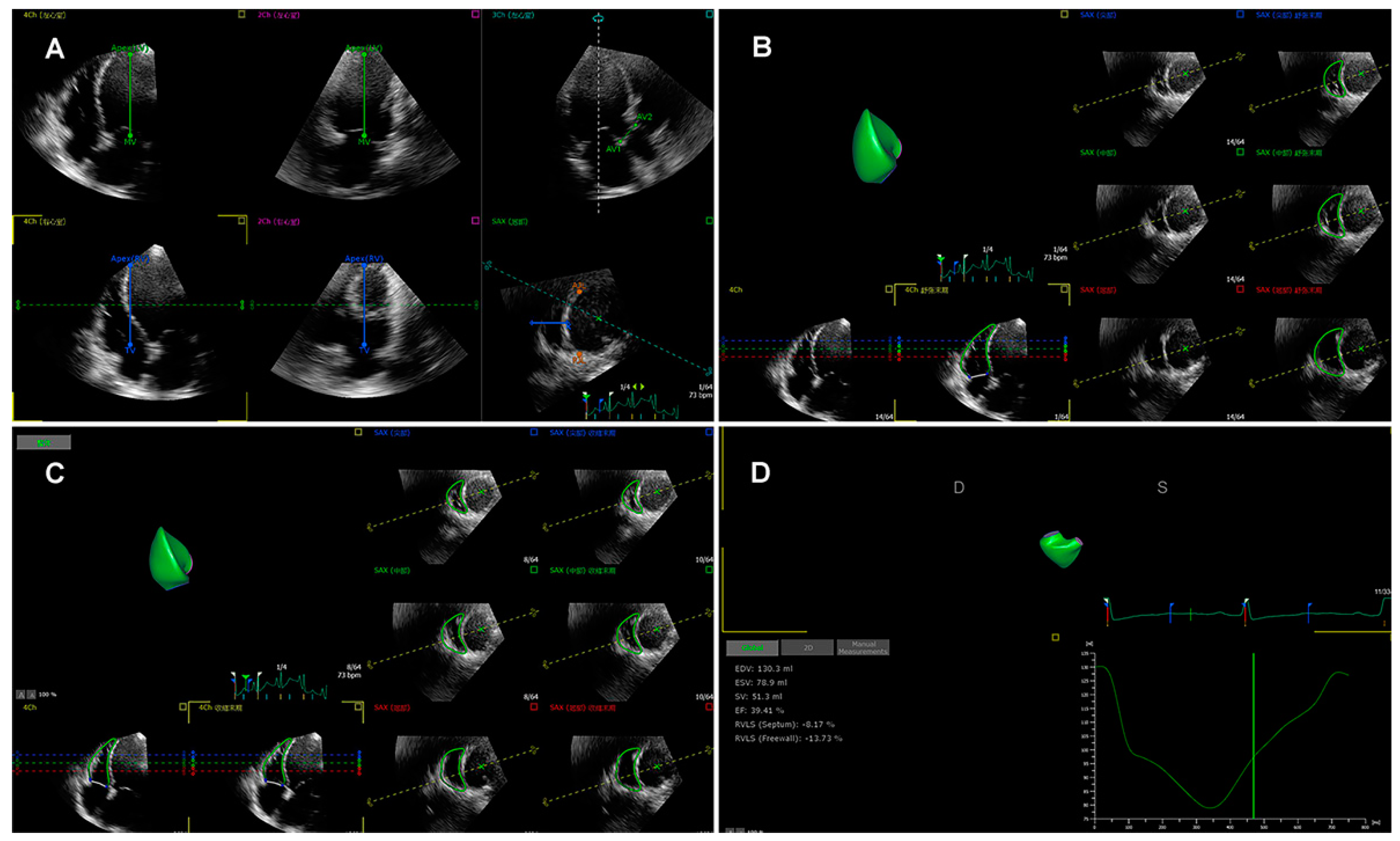 Longitudinal strain by two-dimensional speckle tracking to assess  ventricular function in adults with transposition of the great arteries:  Can serial assessment be simplified?