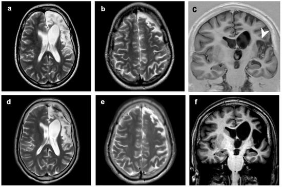 Diagnostics | Free Full-Text | MRI in Late-Onset Rasmussen Encephalitis ...