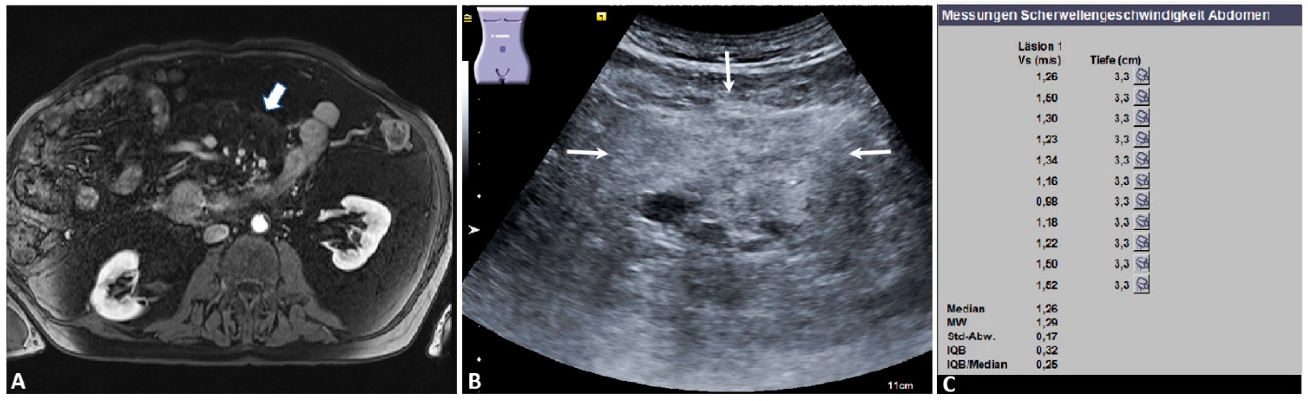 Diagnostics | Free Full-Text | Diagnostic Performance of Point Shear Wave  Elastography (pSWE) Using Acoustic Radiation Force Impulse (ARFI)  Technology in Mesenteric Masses: A Feasibility Study