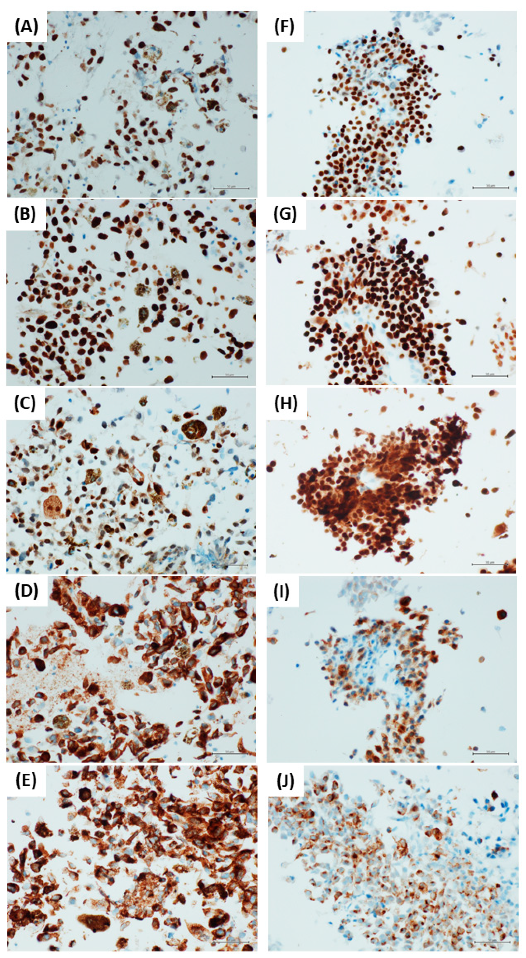 Diagnostics | Free Full-Text | PRAME Immunocytochemistry for the Diagnosis  of Melanoma Metastases in Cytological Samples | HTML