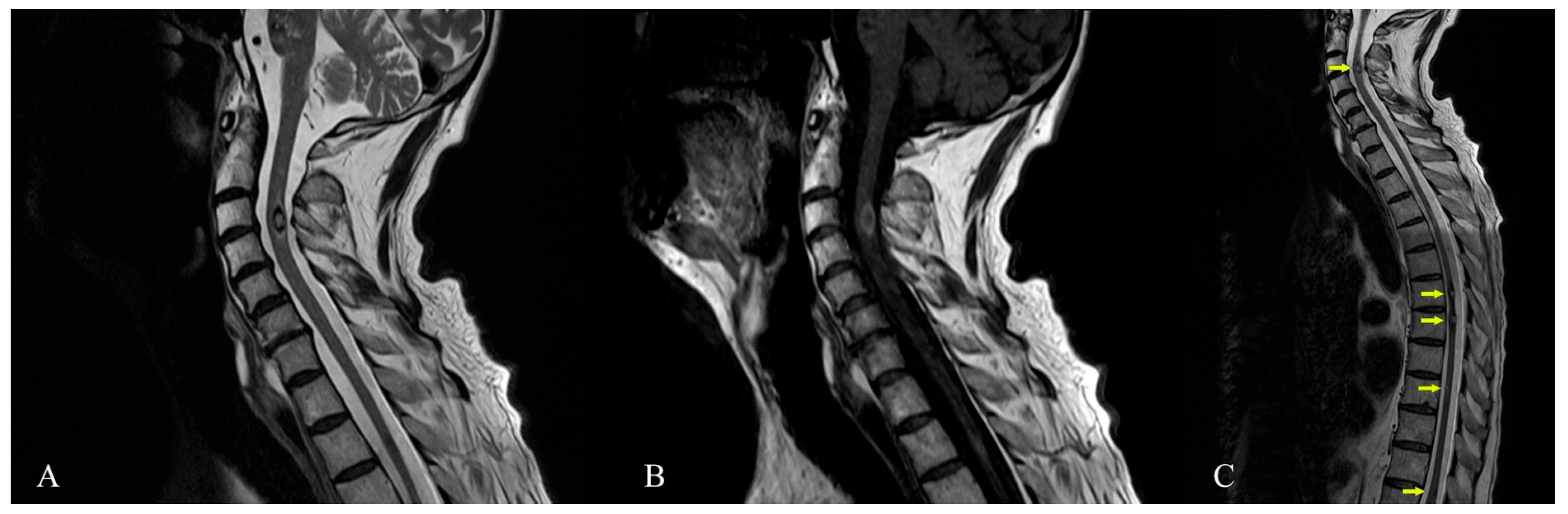 Diagnostics Free Full Text Magnetic Resonance Imaging Of Multiple Cerebral And Spinal