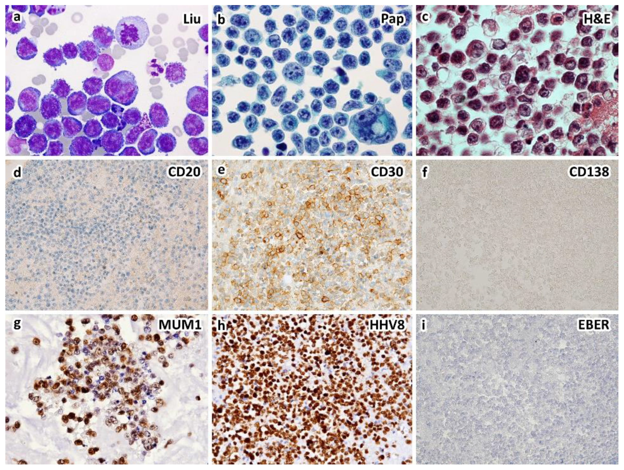 Diagnostics | Free Full-Text | Primary Effusion Lymphoma: A Timely Review  on the Association with HIV, HHV8, and EBV