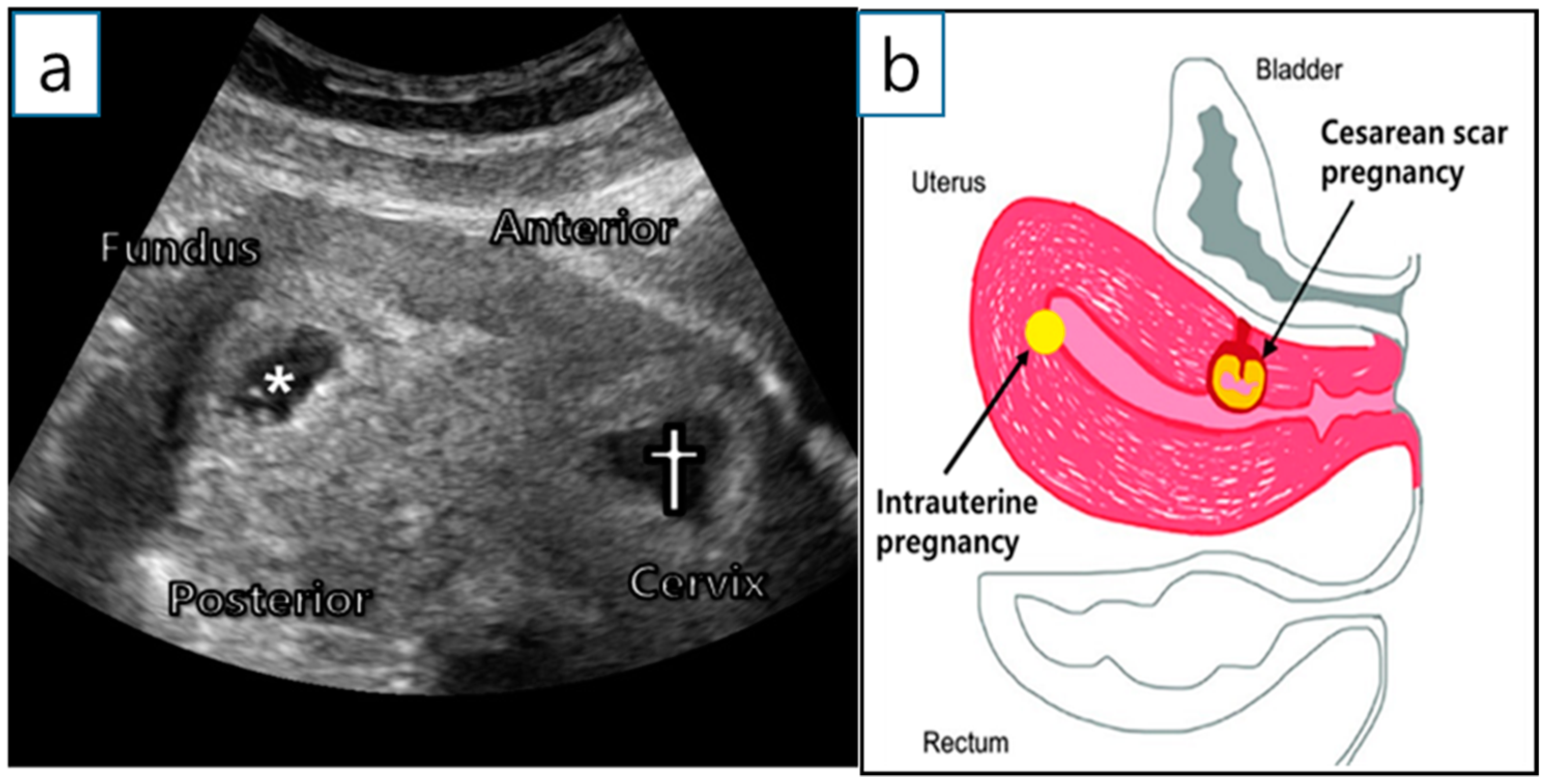 Diagnostics | Free Full-Text | Successful Full-Term Delivery via Selective  Ectopic Embryo Reduction Accompanied by Uterine Cerclage in a Heterotopic Cesarean  Scar Pregnancy: A Case Report and Literature Review