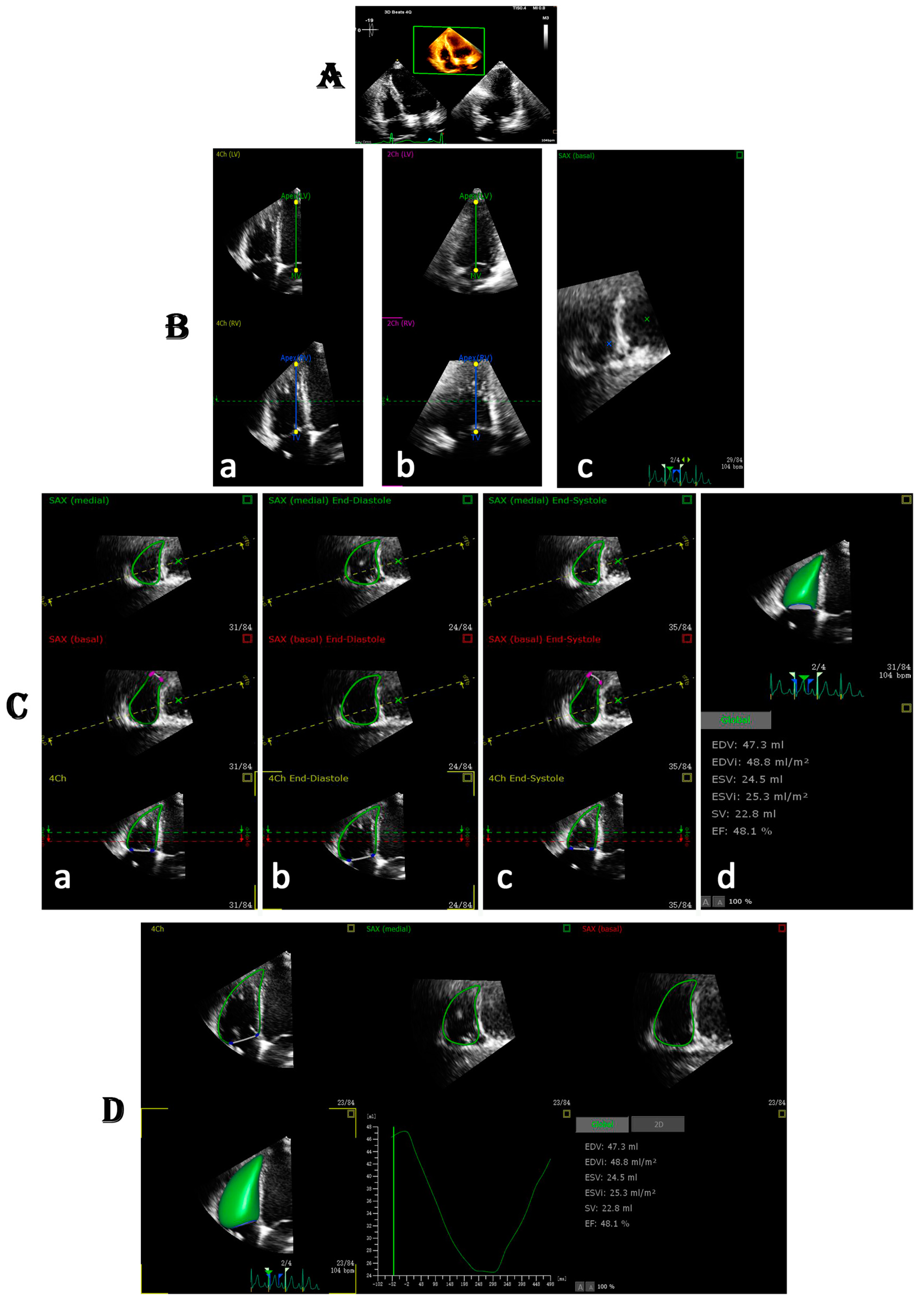 Frontiers  Evaluation of Right Ventricular Myocardial Mechanics by 2- and  3-Dimensional Speckle-Tracking Echocardiography in Patients With an  Ischemic or Non-ischemic Etiology of End-Stage Heart Failure