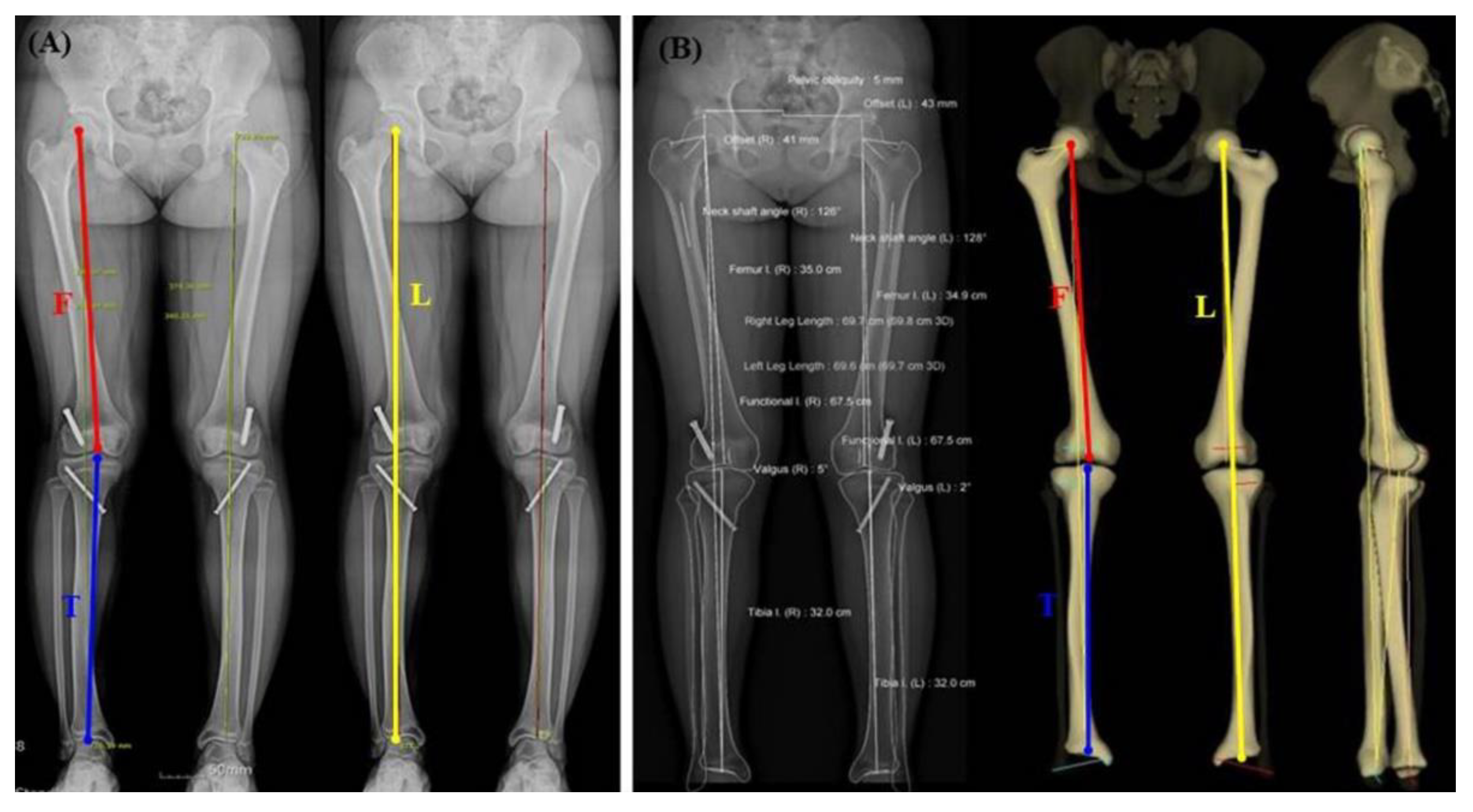 Diagnostics | Free Full-Text | The Comparison of Lower Extremity Length and  Angle between Computed Radiography-Based Teleoroentgenogram and EOS&reg;  Imaging System