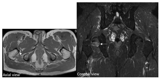 Diagnostics | Free Full-Text | A Swollen Inferior Gemellus Muscle with ...