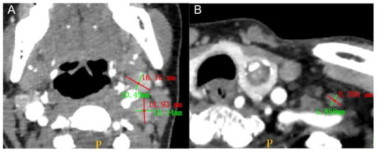 Diagnostics | Free Full-Text | Radiomics Profiling Identifies the Value of  CT Features for the Preoperative Evaluation of Lymph Node Metastasis in  Papillary Thyroid Carcinoma