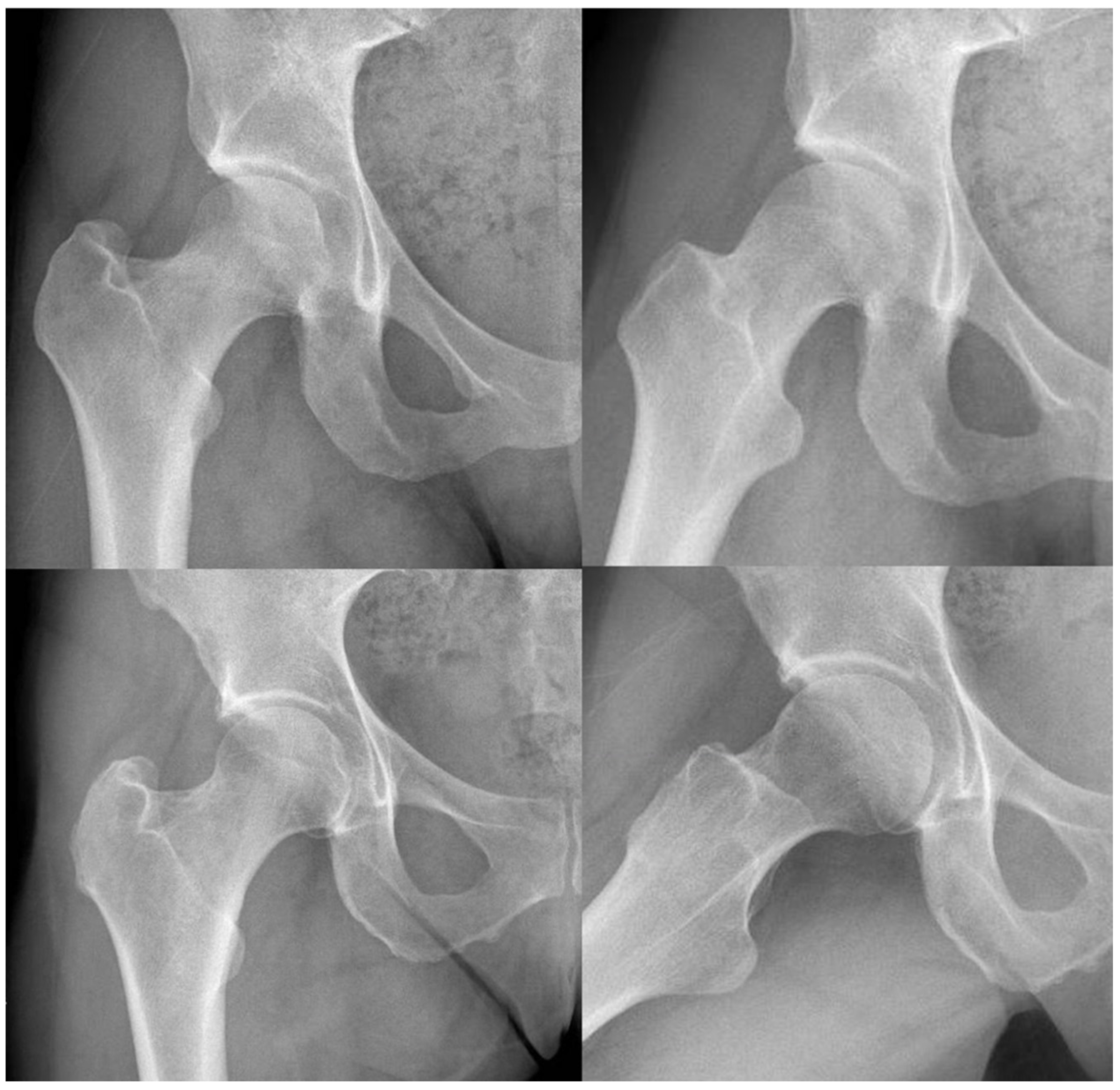 Diagnostics | Free Full-Text | Hip Preservation Surgery in Osteoarthritis  Prevention: Potential Benefits of the Radiographic Angular Correction