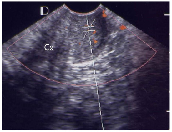 Diagnostics | Free Full-Text | Cervical Power Doppler Angiography with  Micro Vessel Blood Flow Indices in the Auxiliary Diagnosis of Acute  Cervicitis
